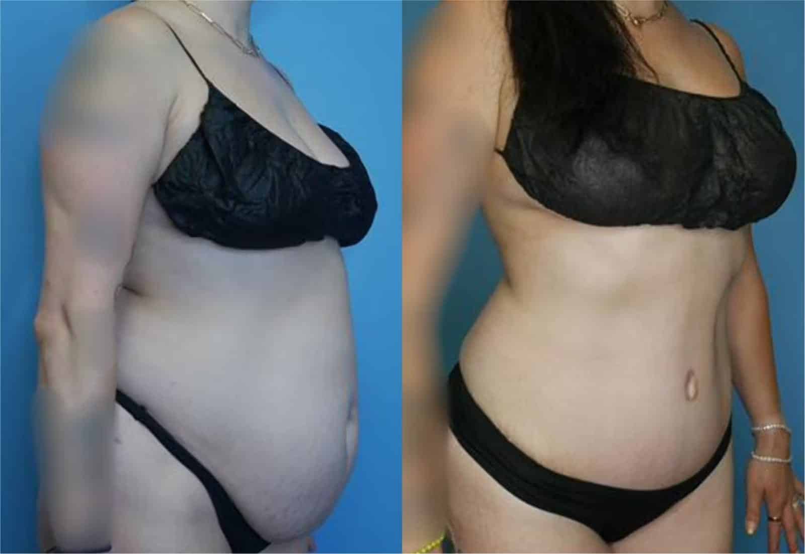 Before and After Image: Mommy Makeover - right-side