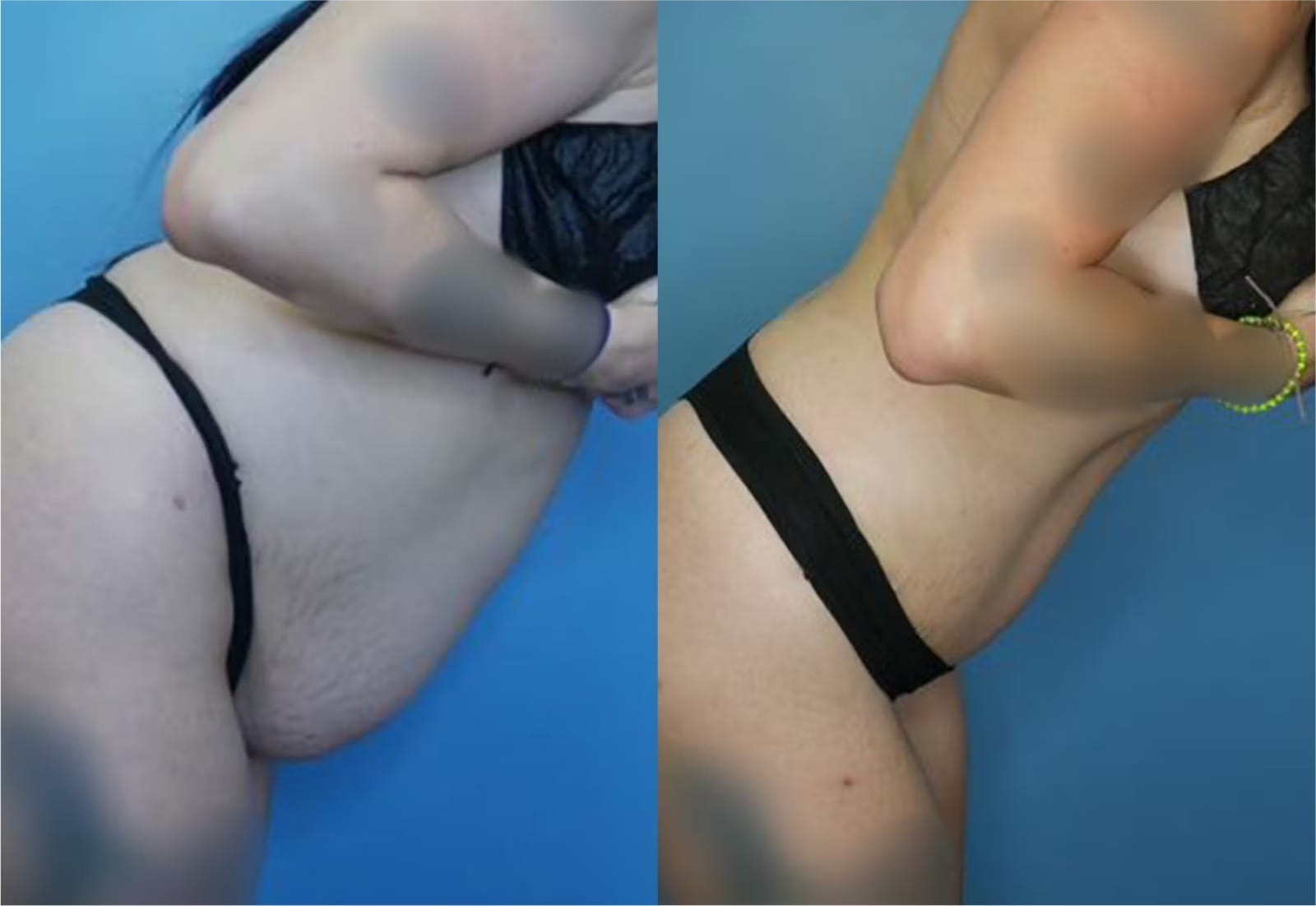 Before and After Image: Mommy Makeover - right-side