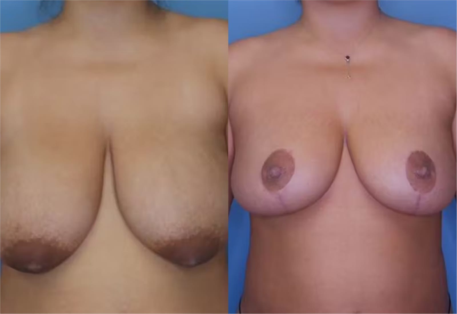 Before and After Image: Mommy Makeover - front