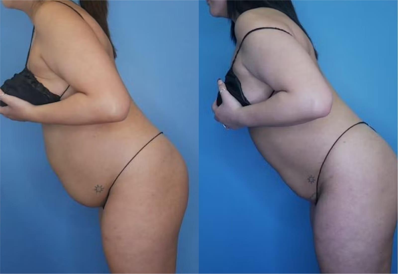 Before and After Image: Mommy Makeover - left-side