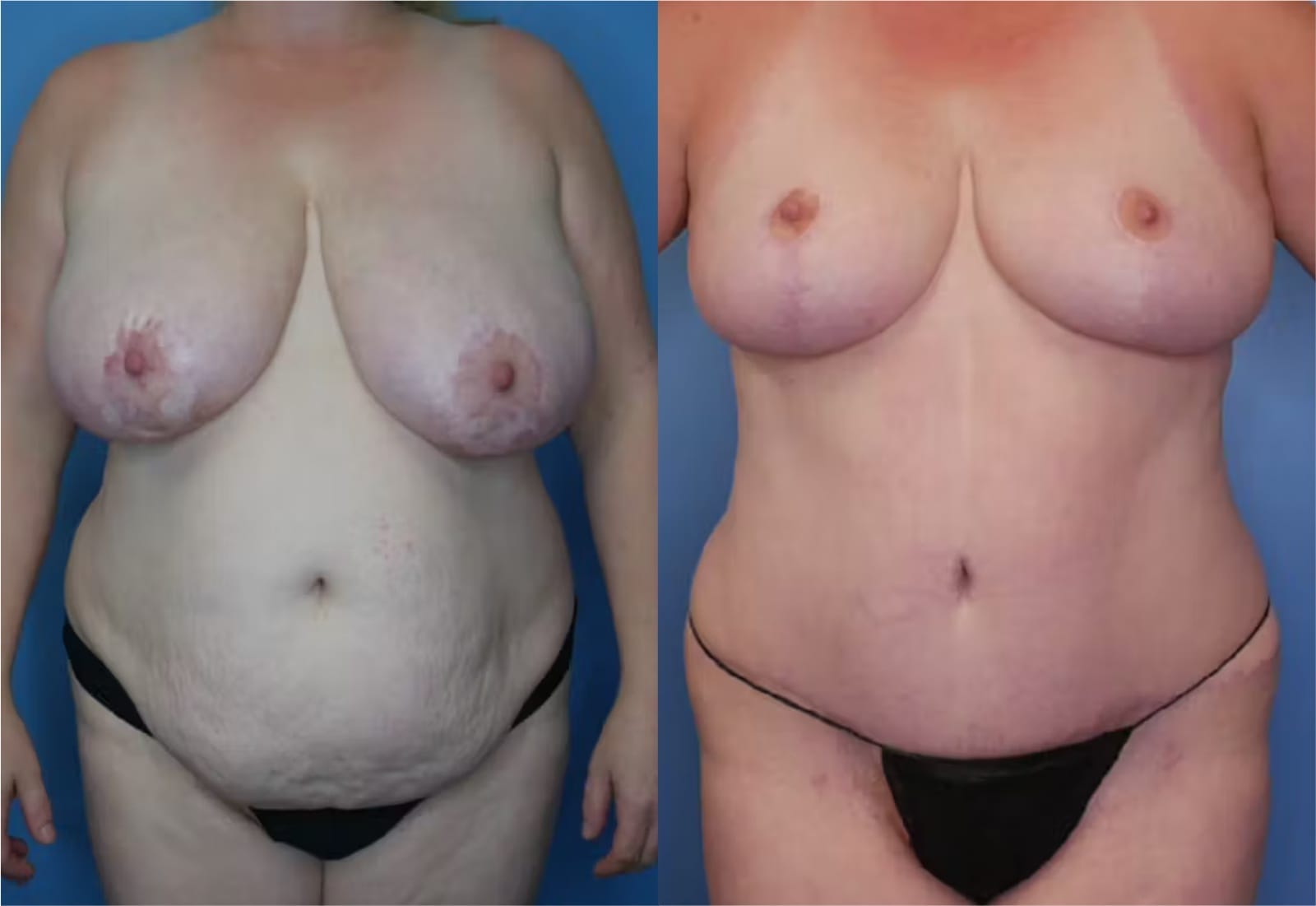 Before and After Image: Mommy Makeover - front