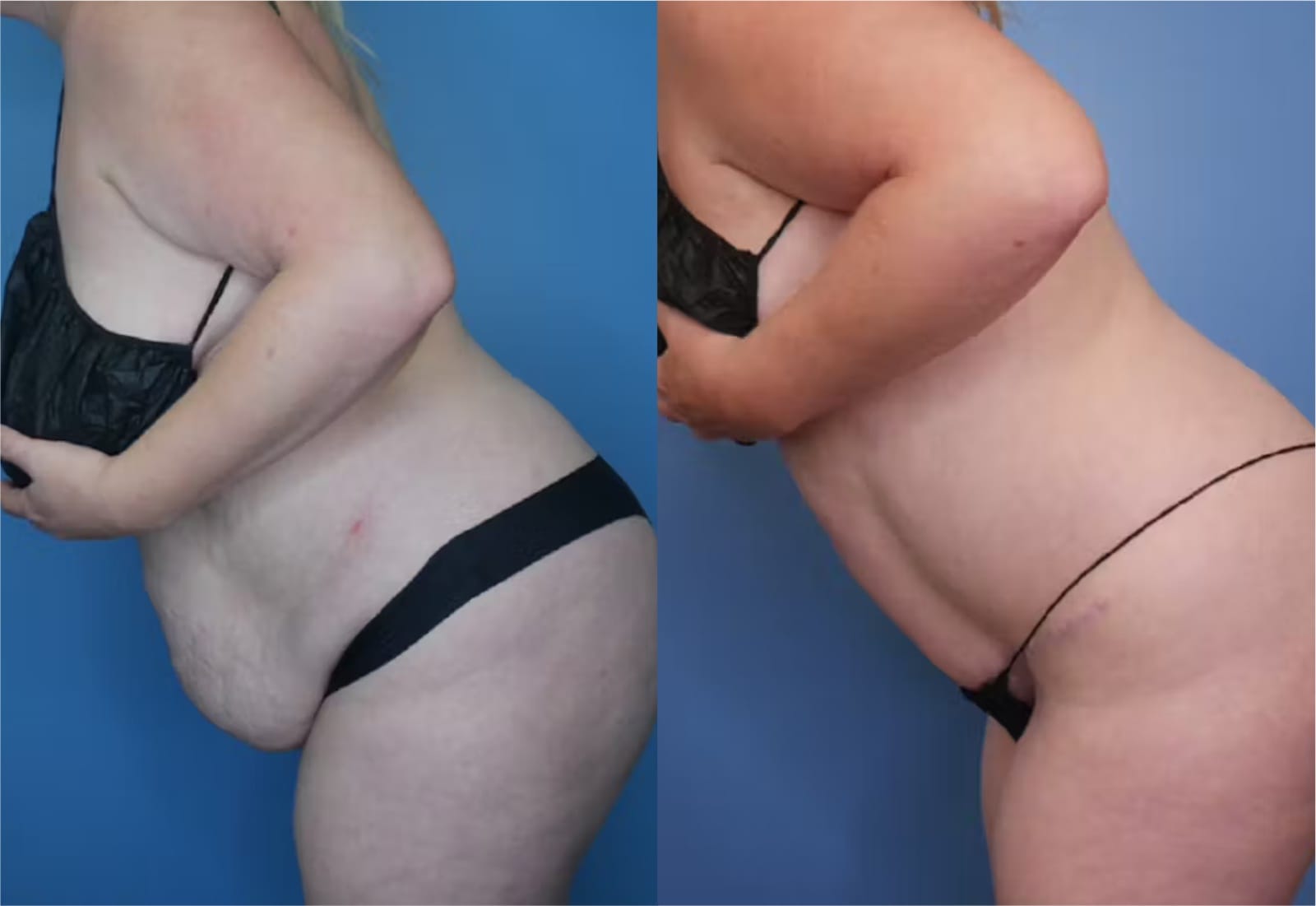 Before and After Image: Mommy Makeover - left-side