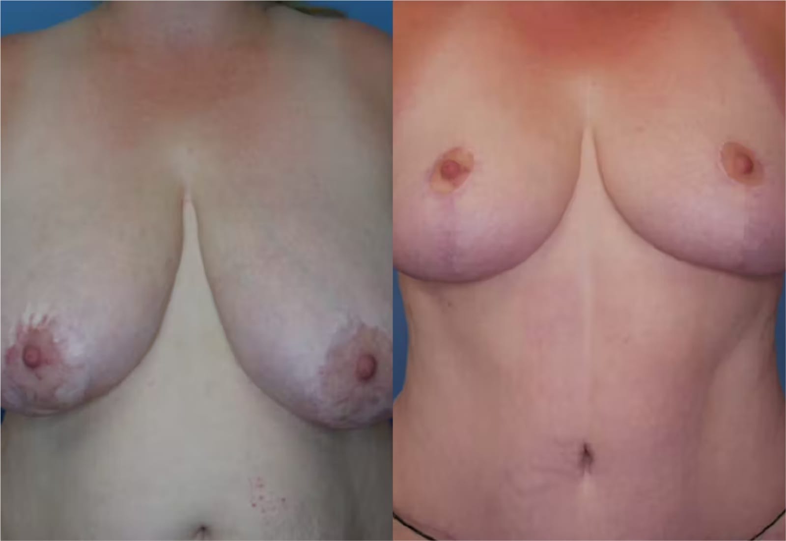 Before and After Image: Mommy Makeover - front