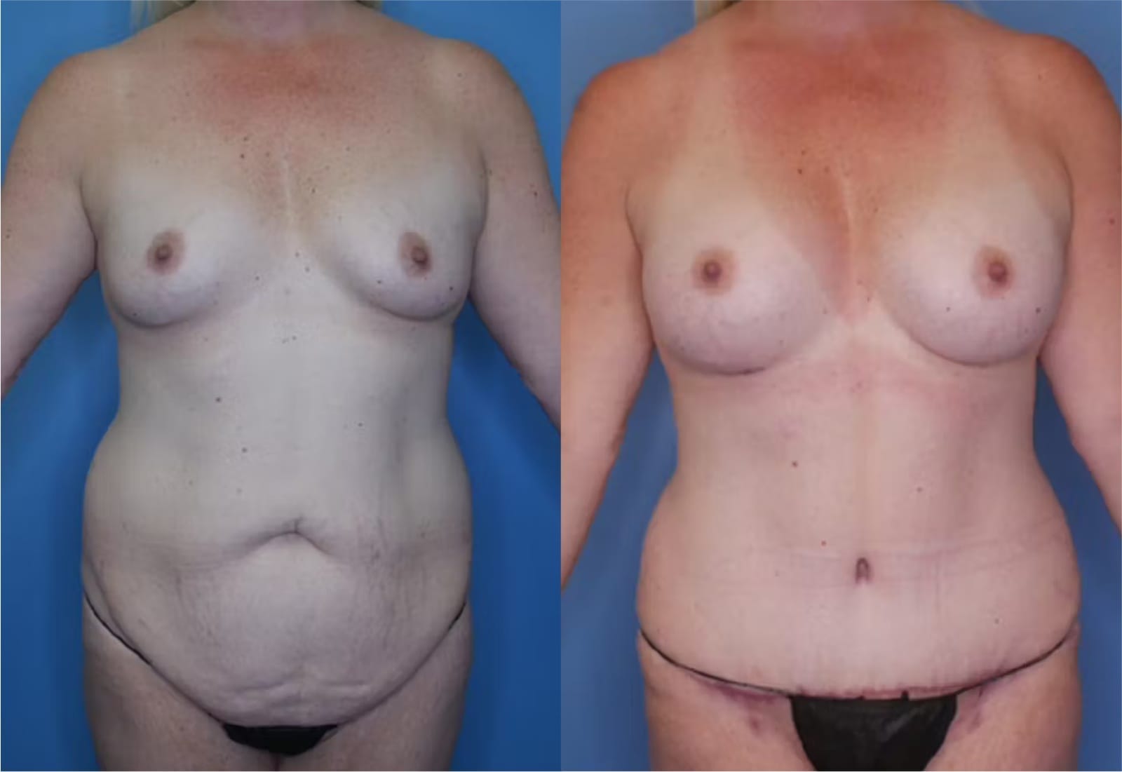 Before and After Image: Mommy Makeover - front