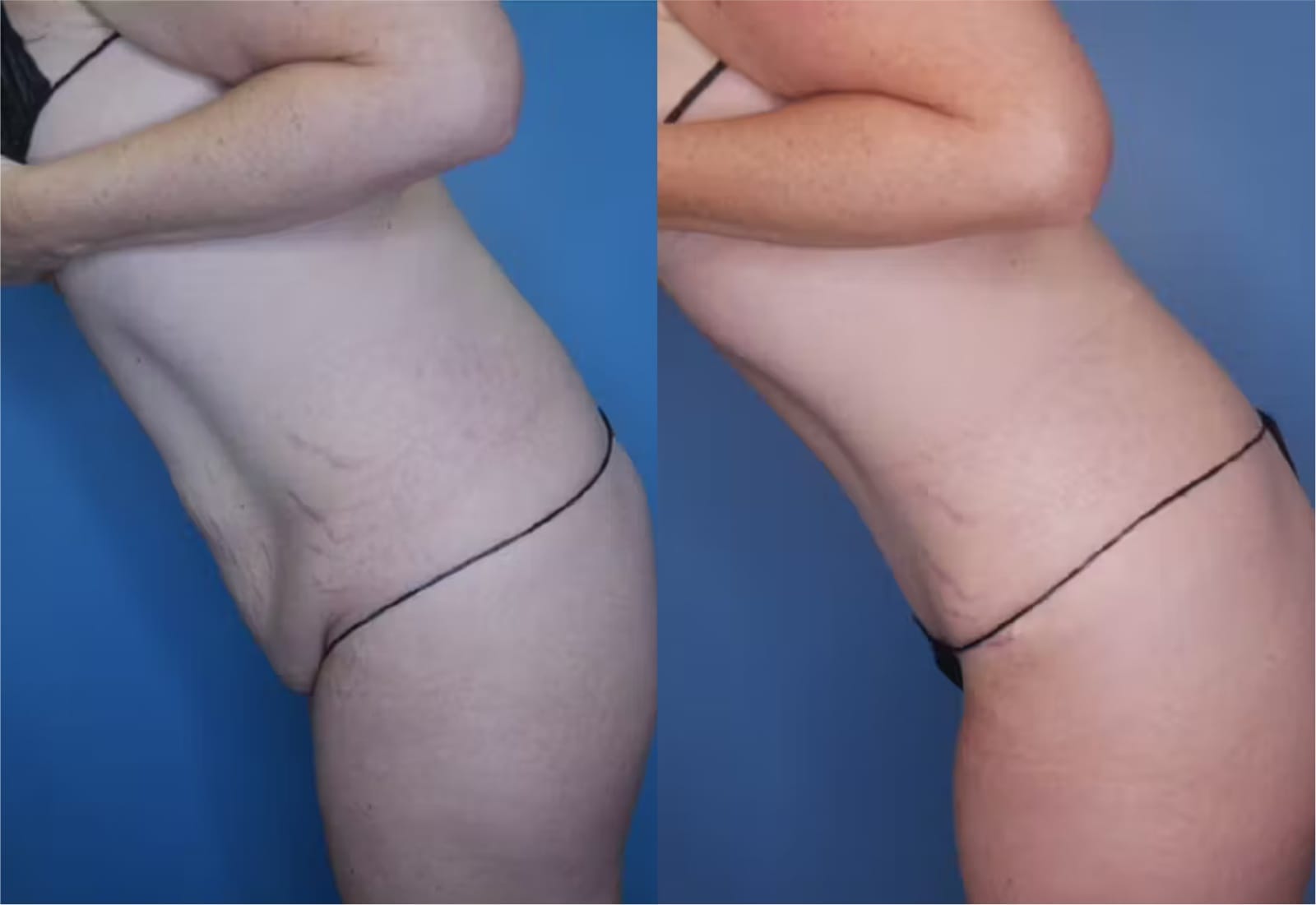 Before and After Image: Mommy Makeover - left-side