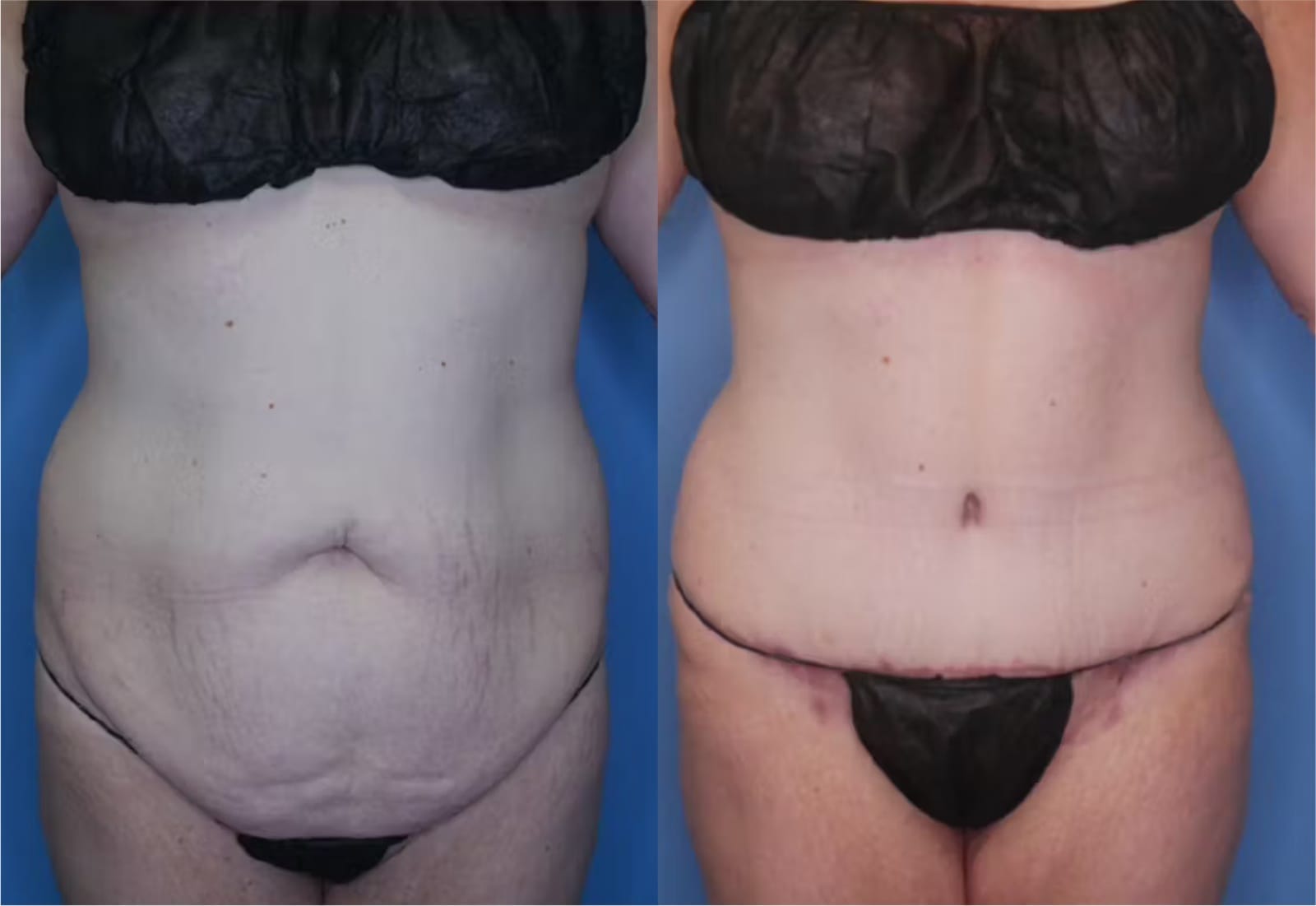 Before and After Image: Mommy Makeover - front