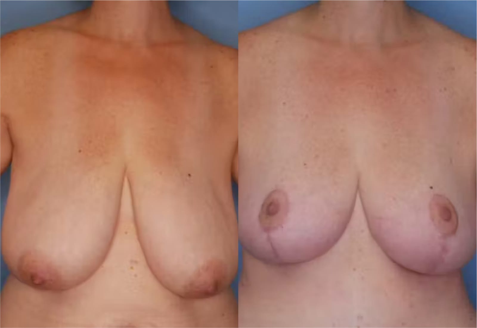 Before and After Image: Mommy Makeover - front