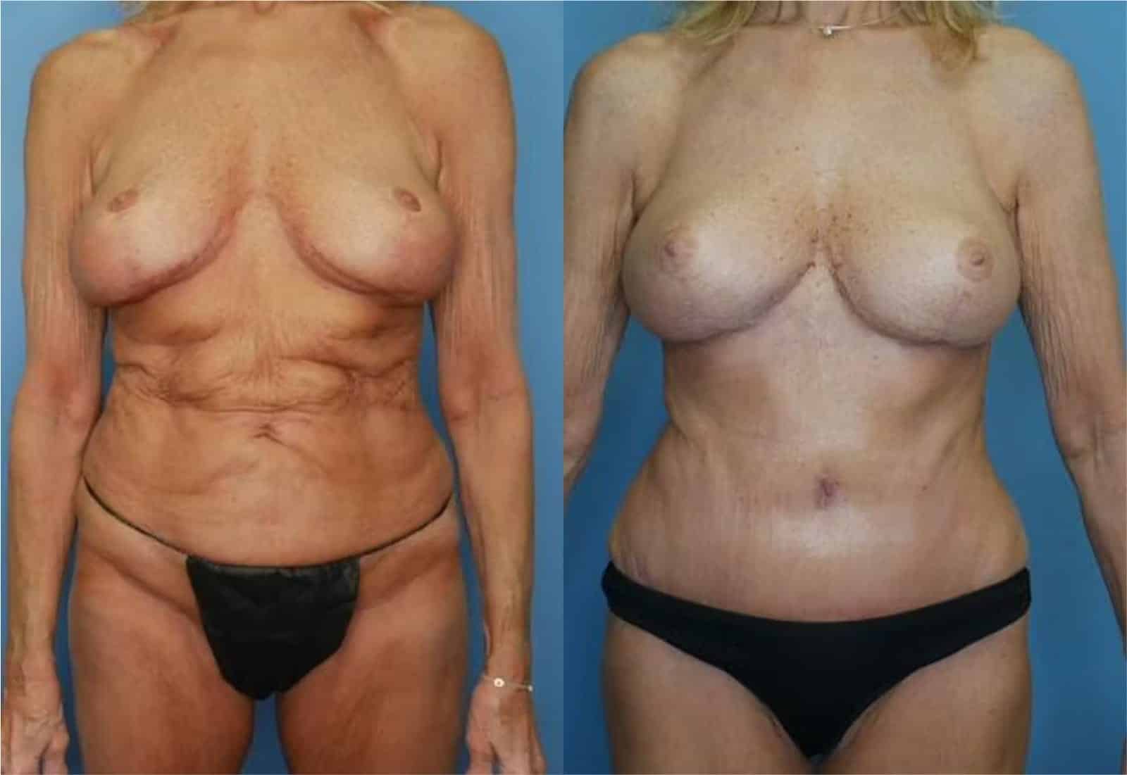 Before and After Image: Mommy Makeover - front