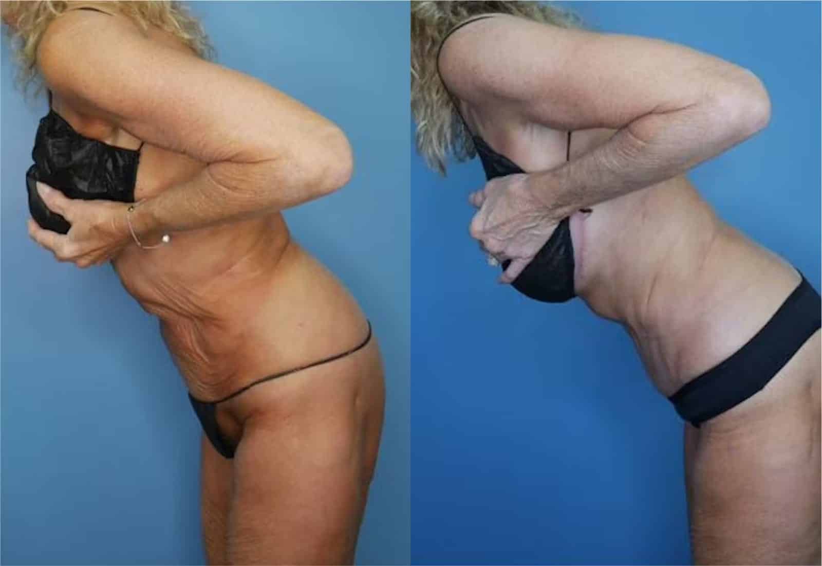 Before and After Image: Mommy Makeover - left-side