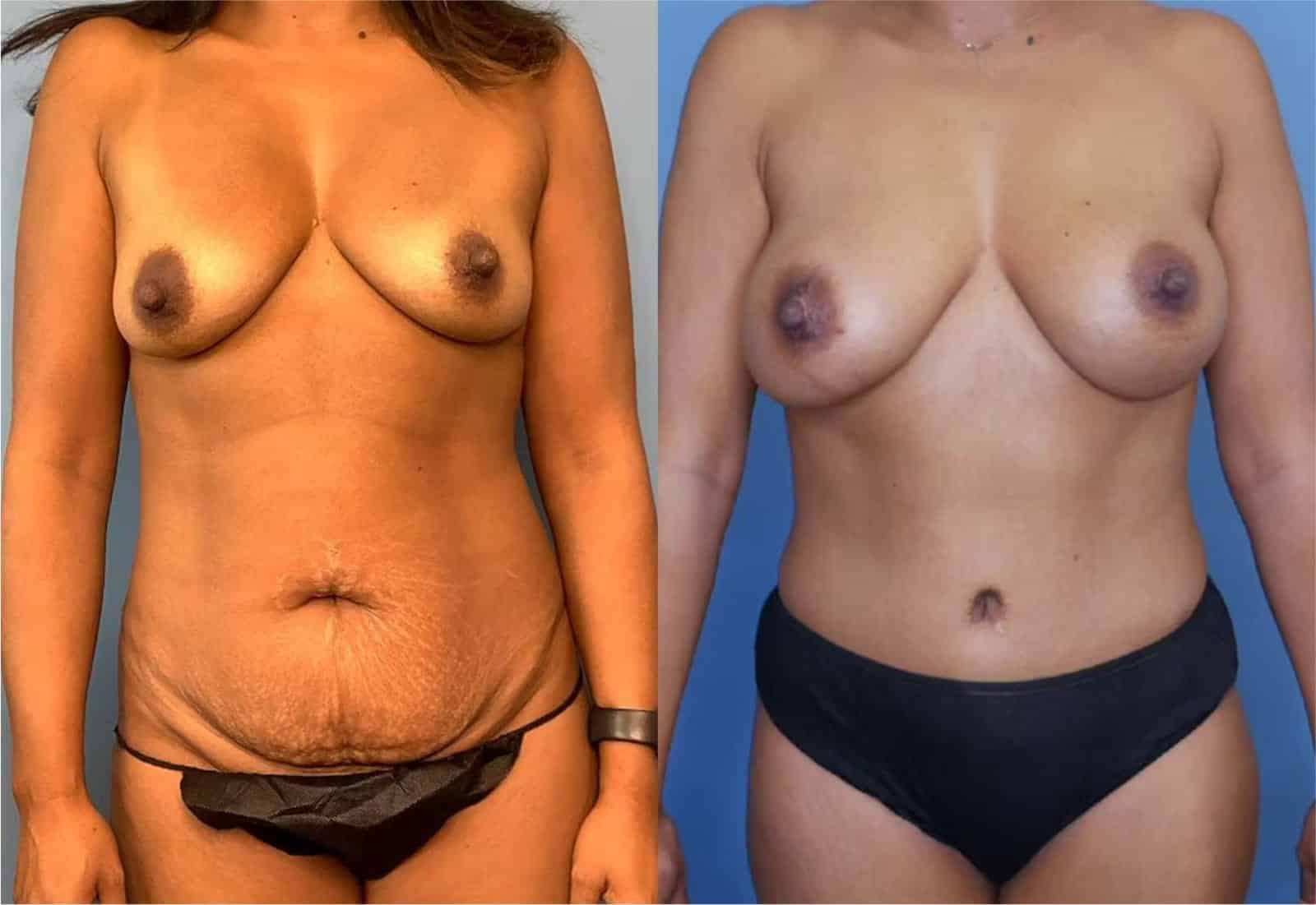 Before and After Image: Mommy Makeover - front