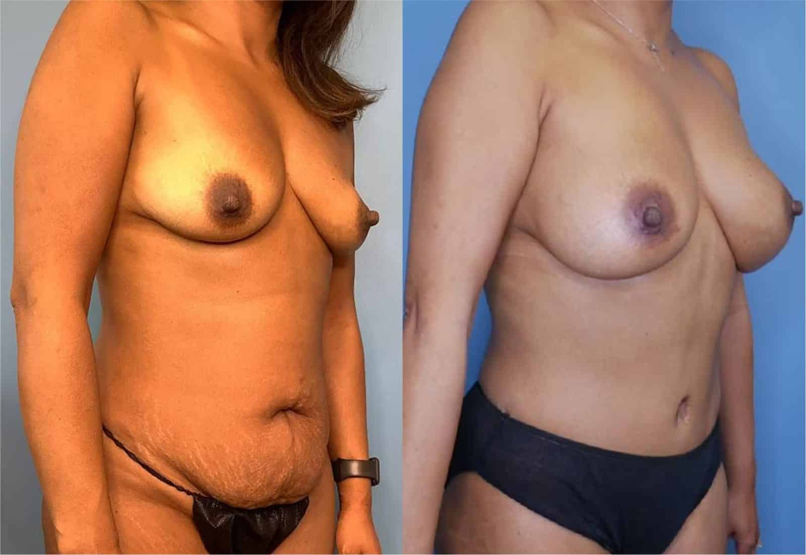 Before and After Image: Mommy Makeover - right-front-oblique
