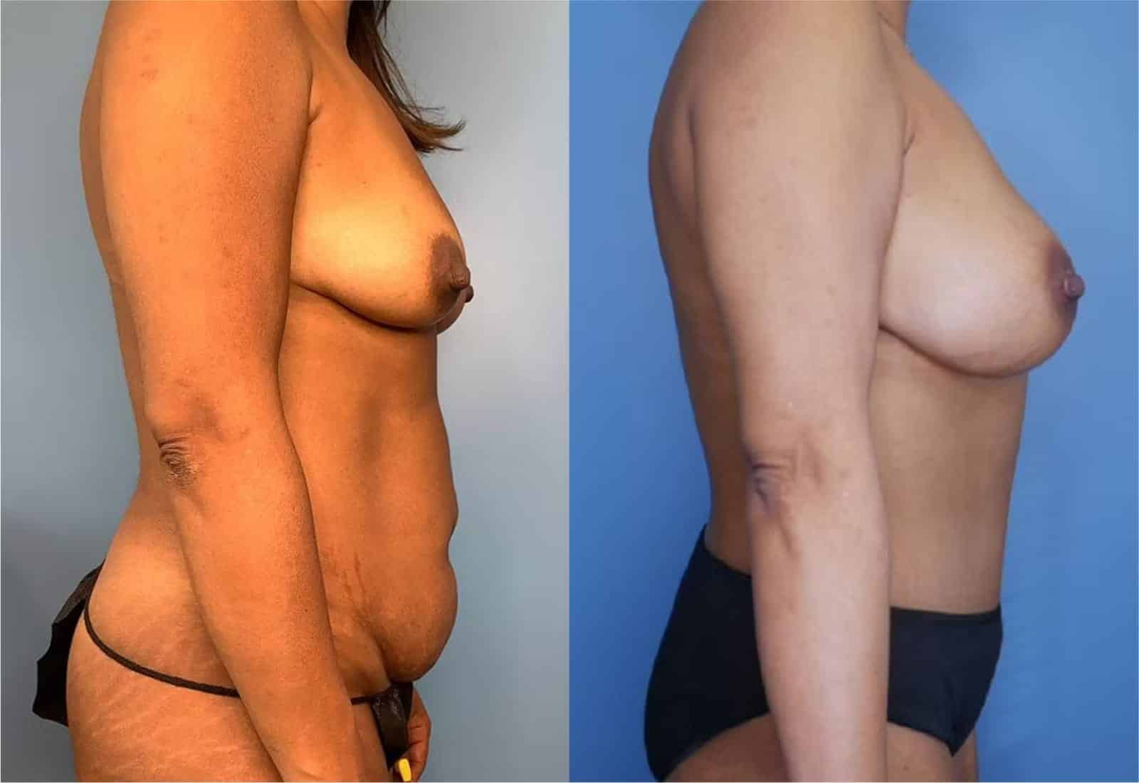 Before and After Image: Mommy Makeover - right-side