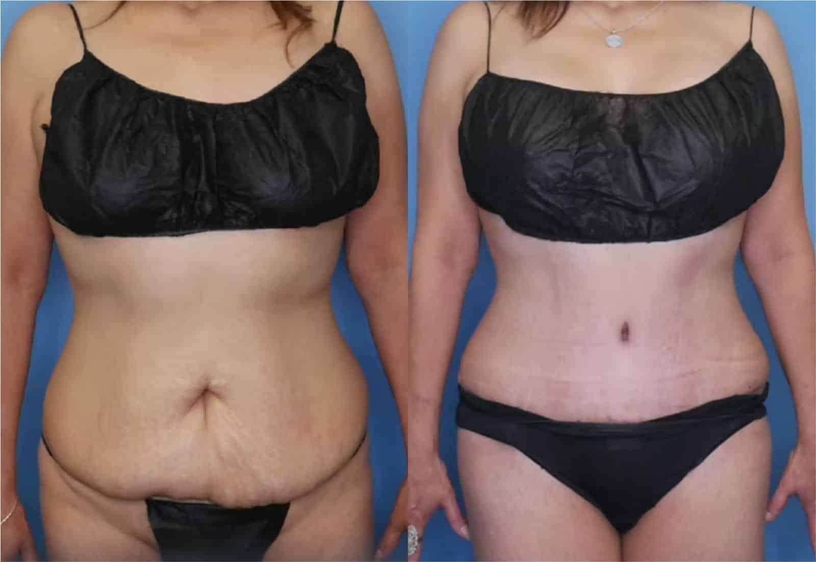 Before and After Image: Mommy Makeover - front