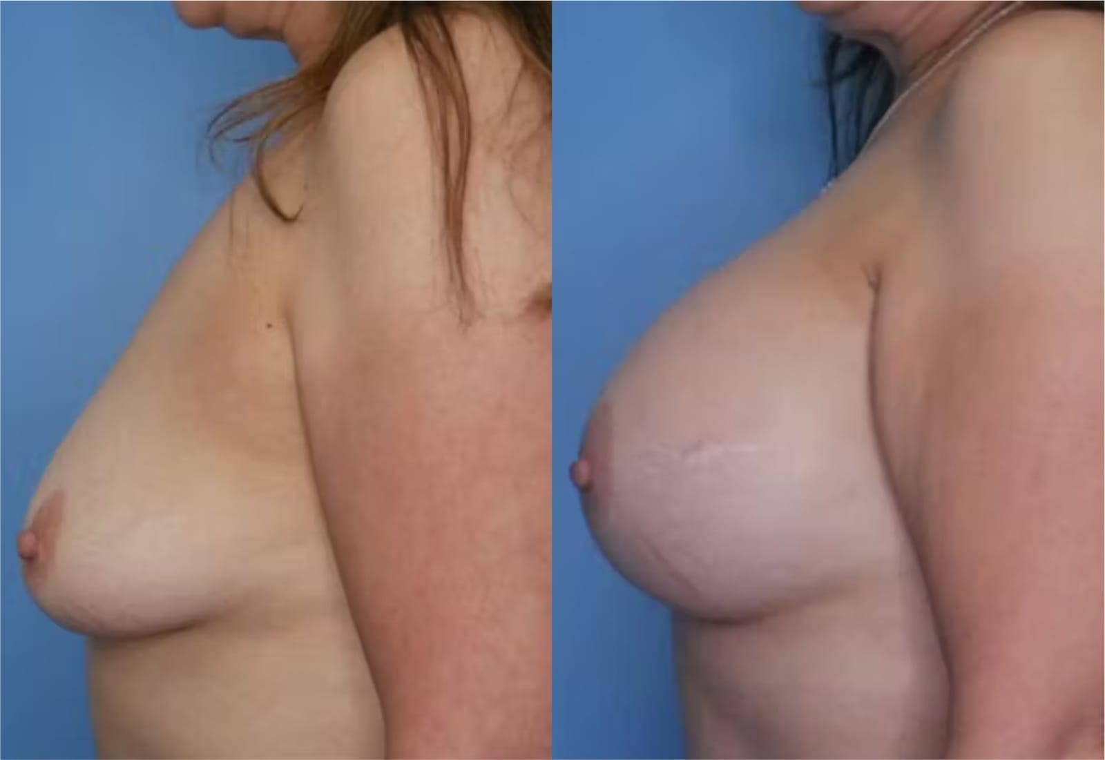 Before and After Image: Mommy Makeover - left-side