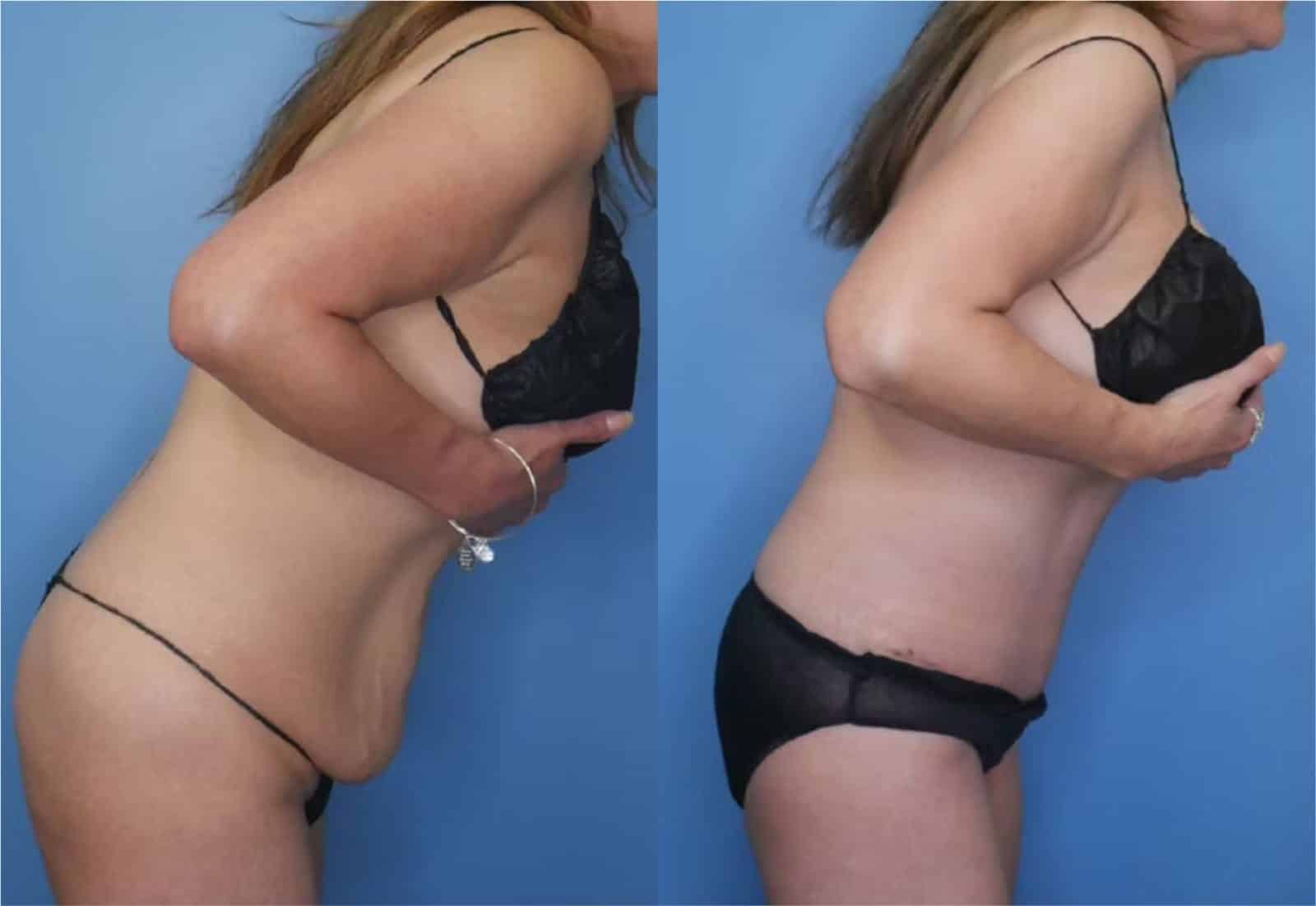 Before and After Image: Mommy Makeover - right-side