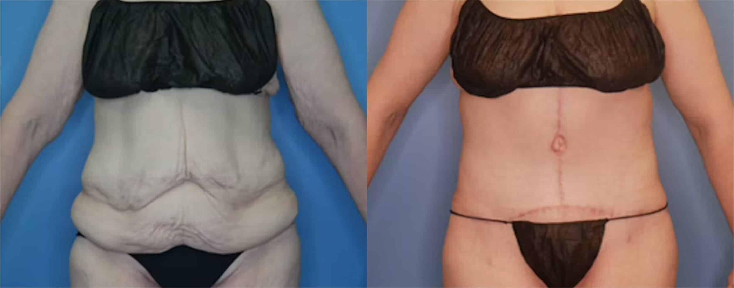 Before and After Image: Massive Weight Loss - front