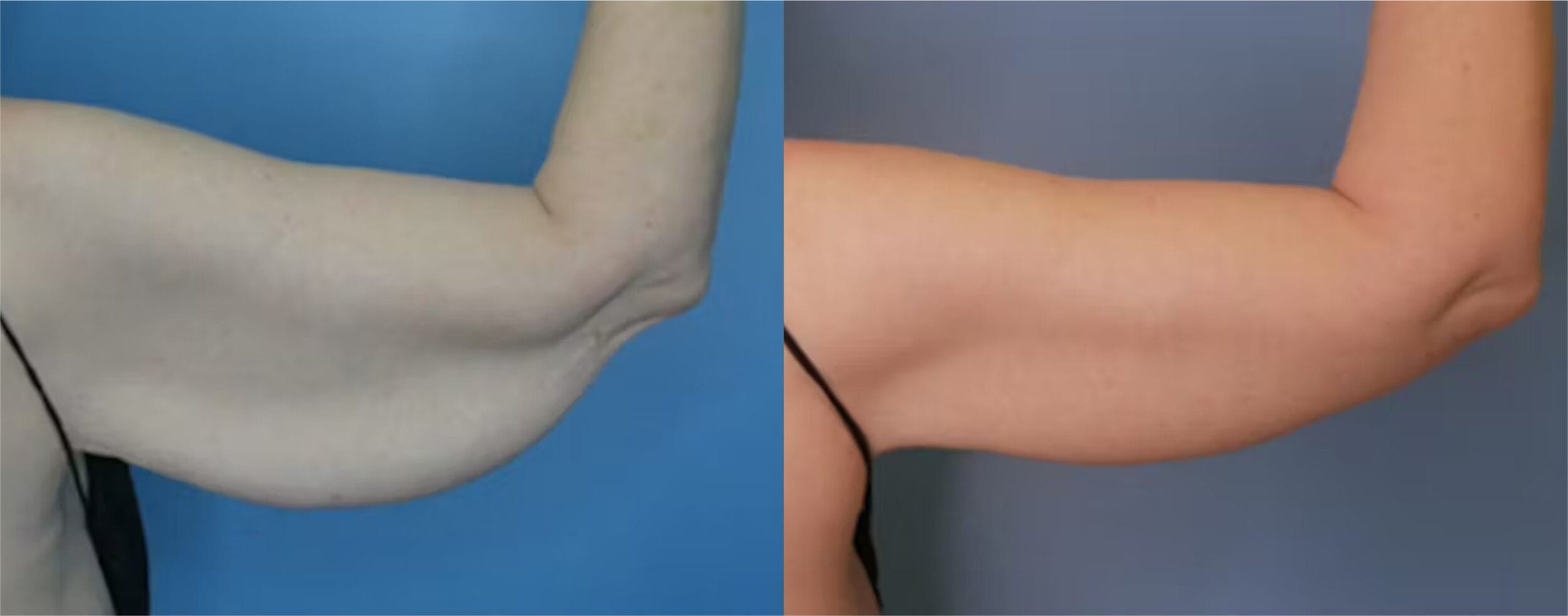 Before and After Image: Massive Weight Loss - back