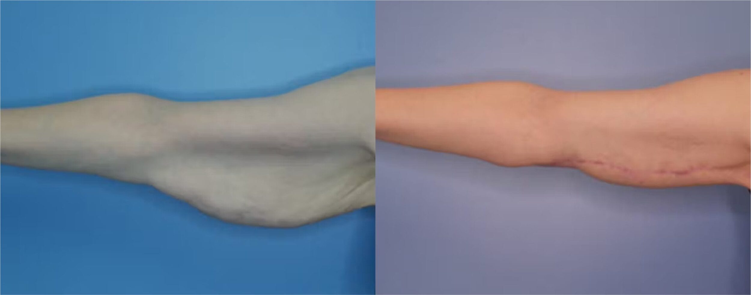 Before and After Image: Massive Weight Loss - front