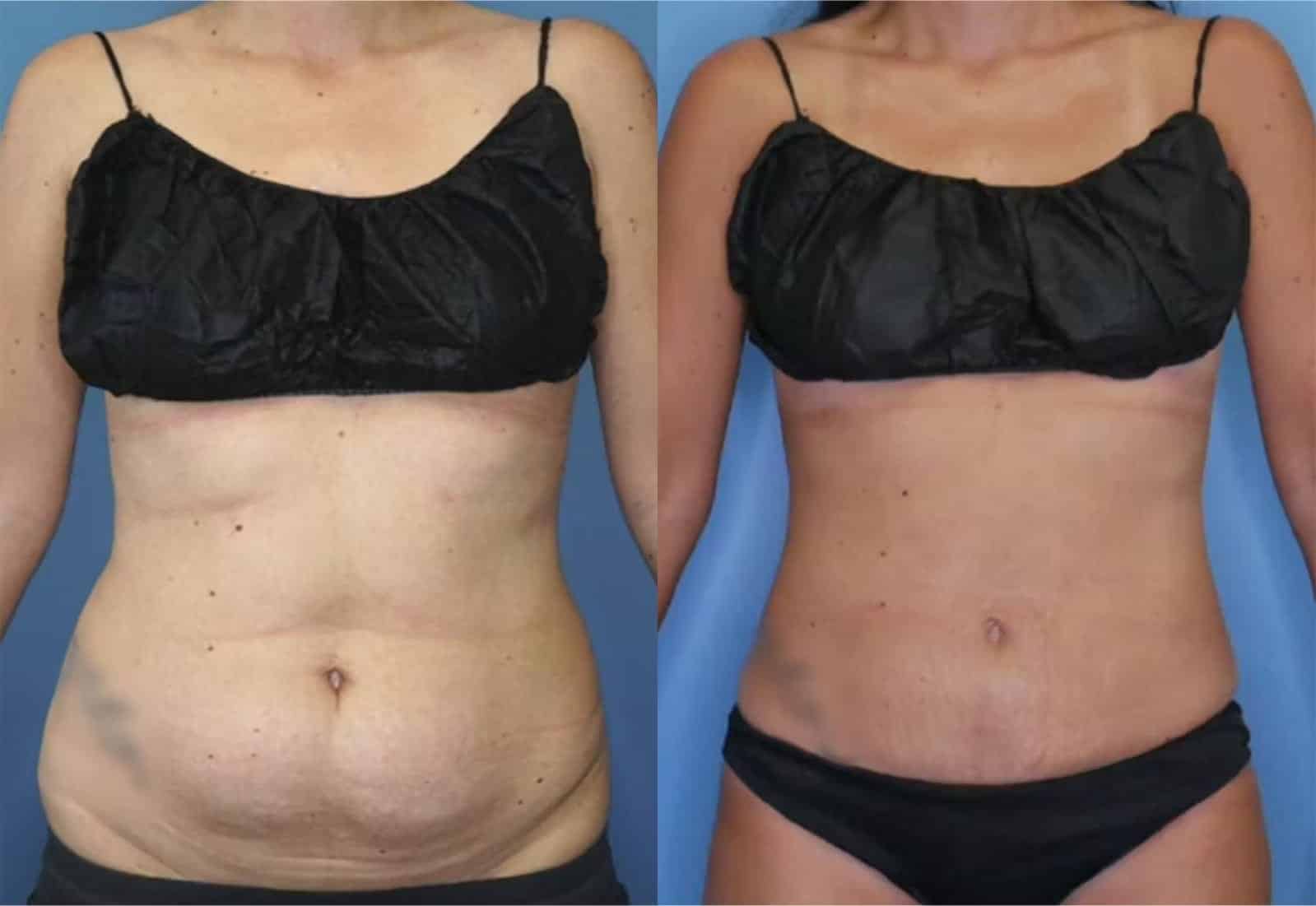 Before and After Image: Mini Tummy Tuck - front
