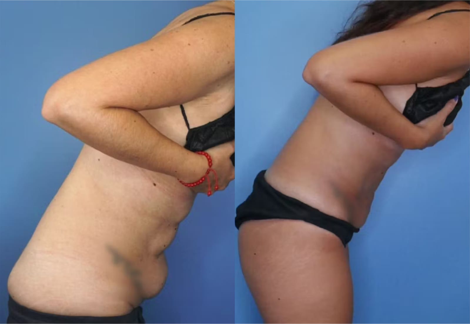 Before and After Image: Mini Tummy Tuck - right-side