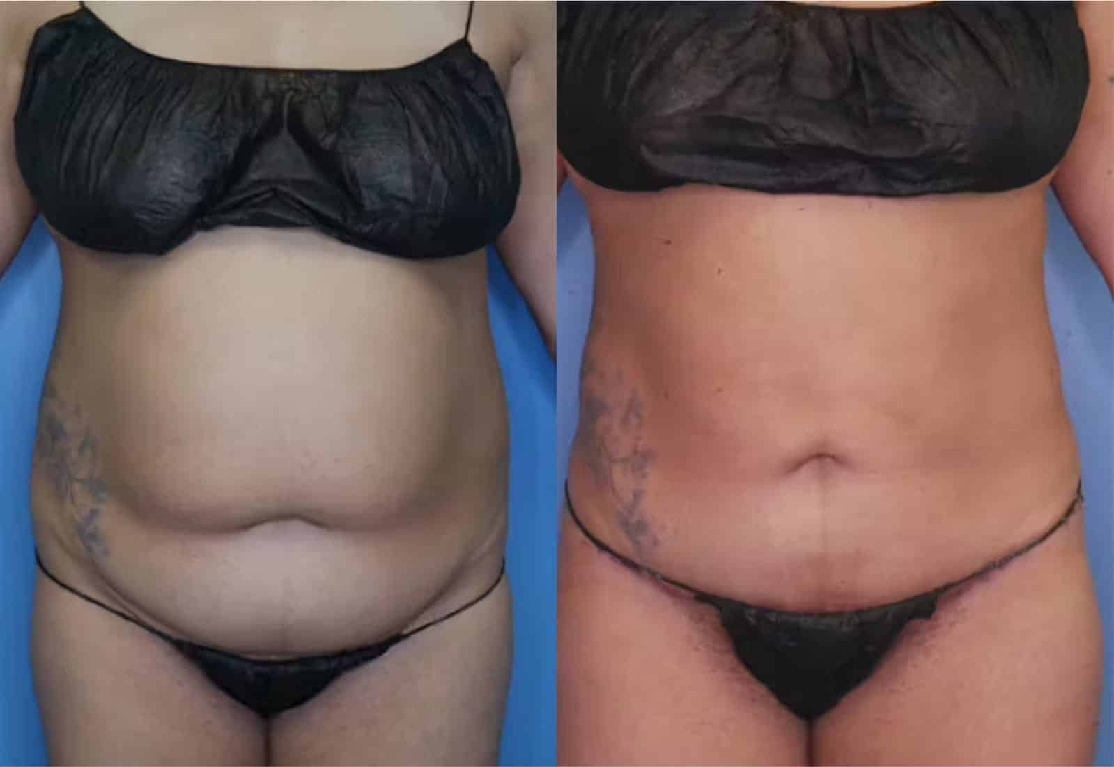 Before and After Image: Mini Tummy Tuck - front