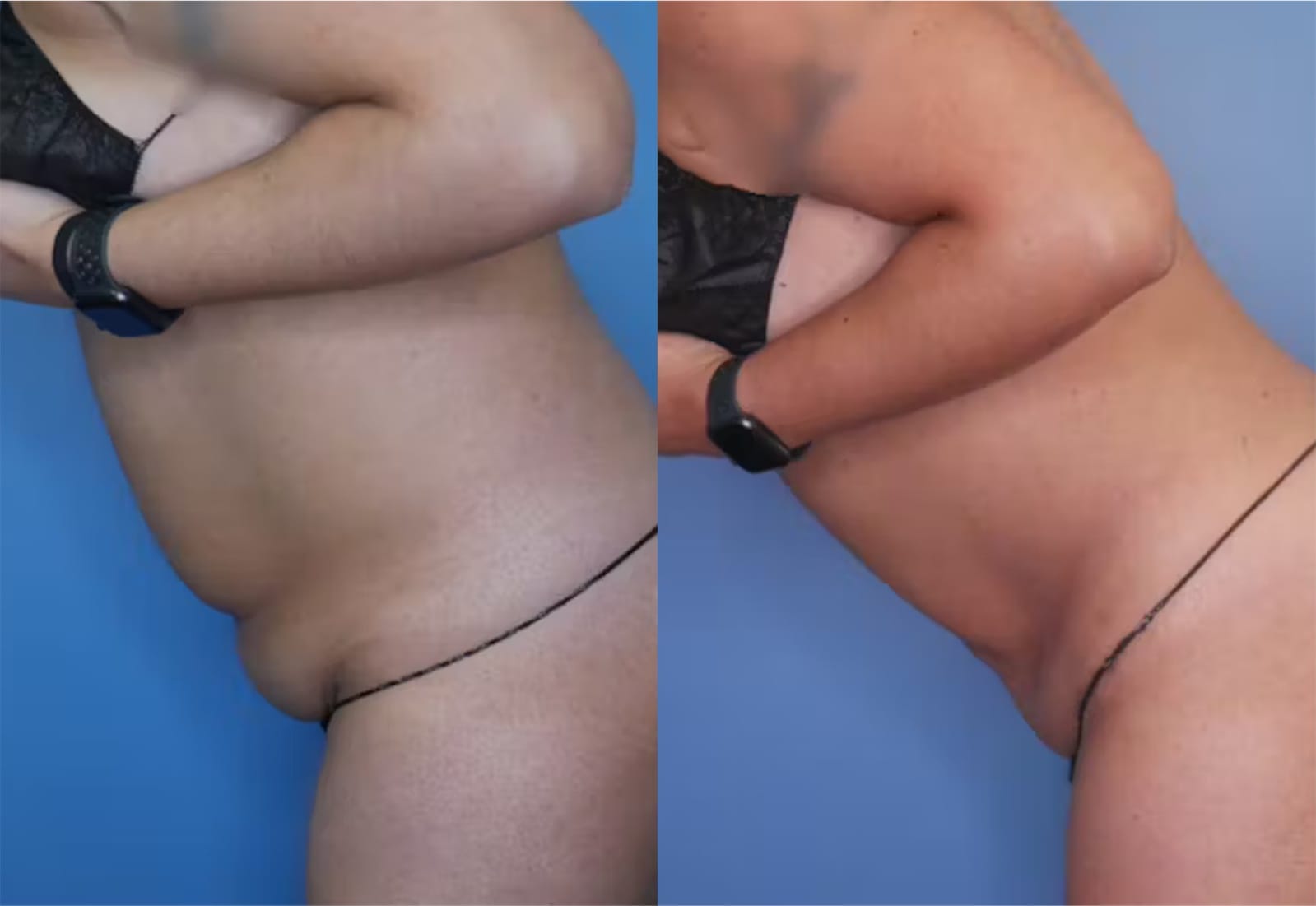 Before and After Image: Mini Tummy Tuck - left-side
