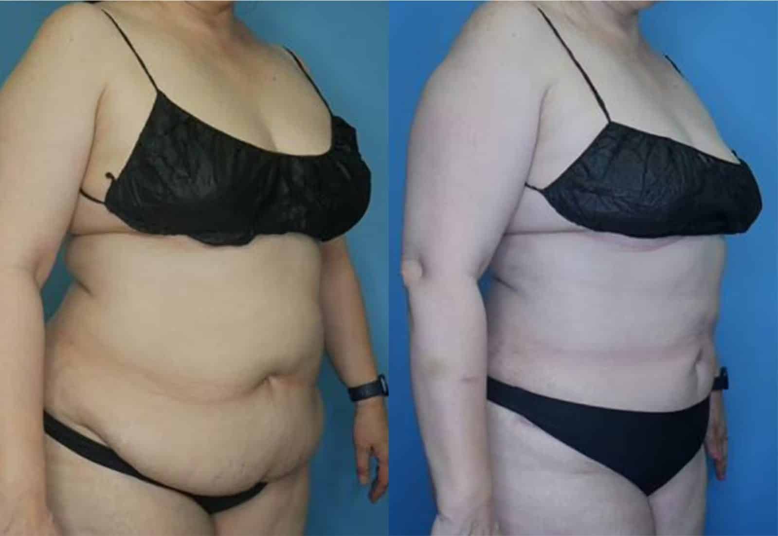 Before and After Image: Mini Tummy Tuck - right-front-oblique