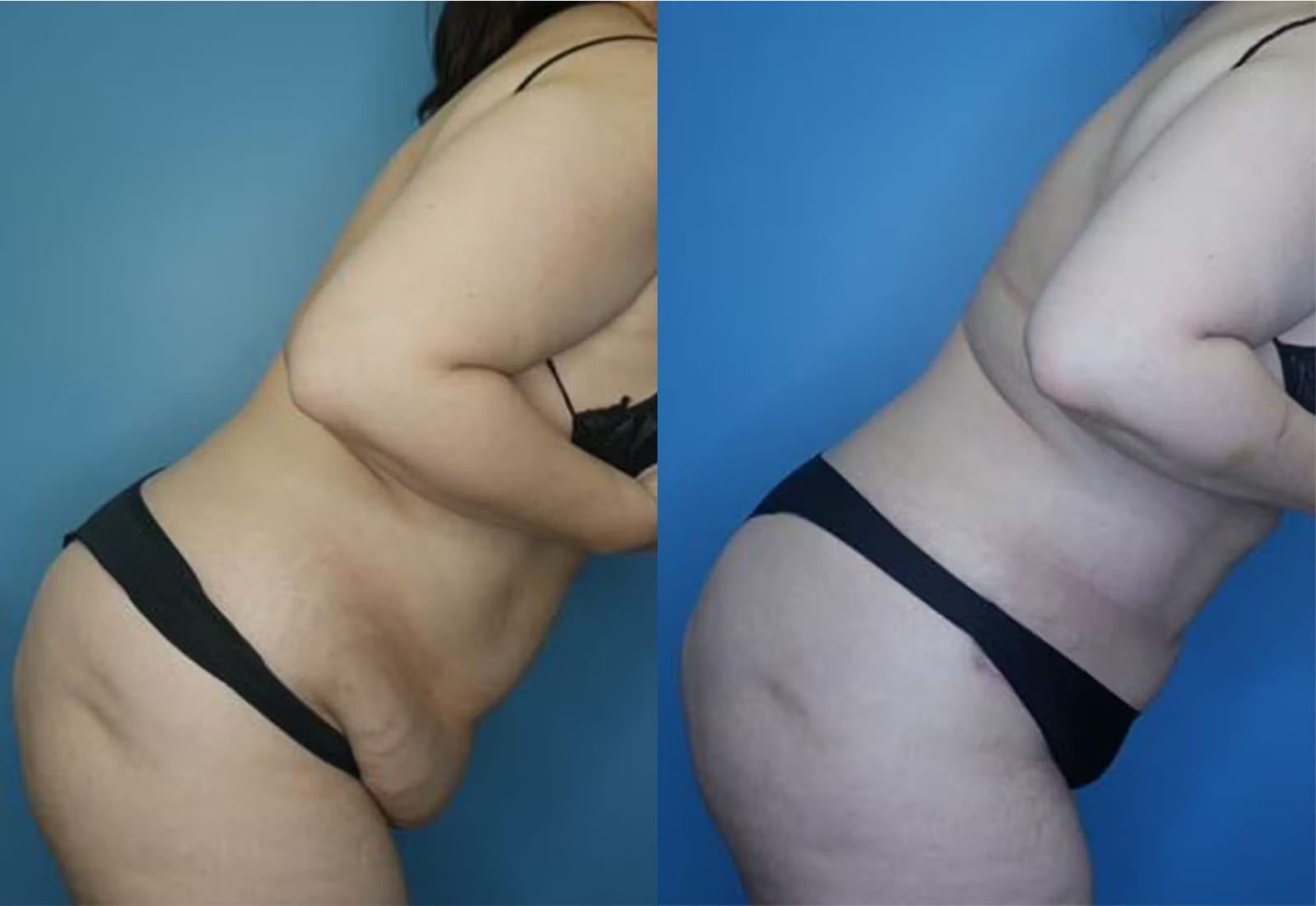 Before and After Image: Mini Tummy Tuck - right-side