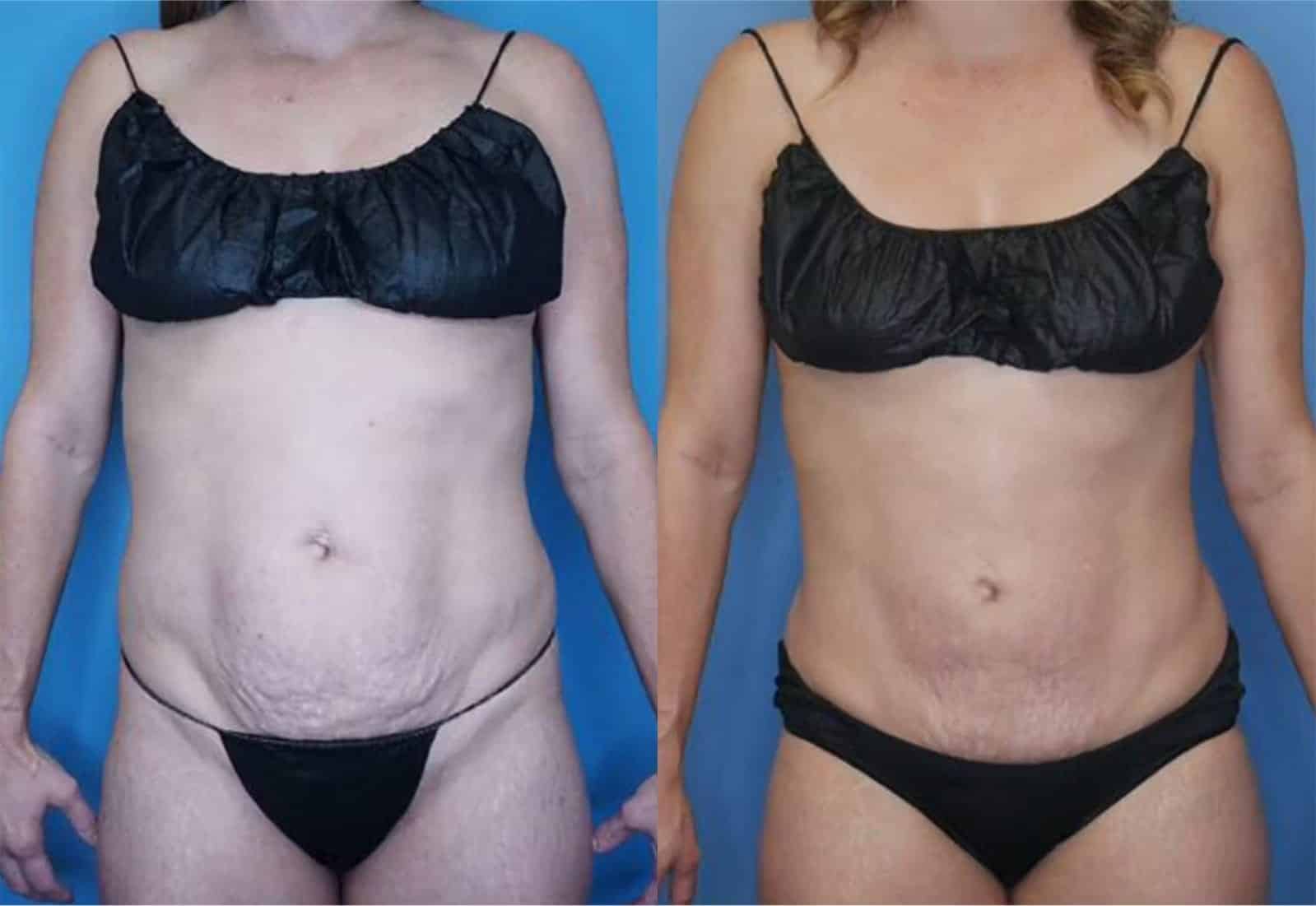 Before and After Image: Mini Tummy Tuck - front