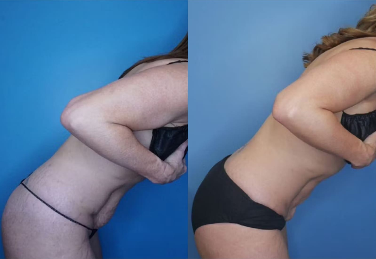 Before and After Image: Mini Tummy Tuck - right-side