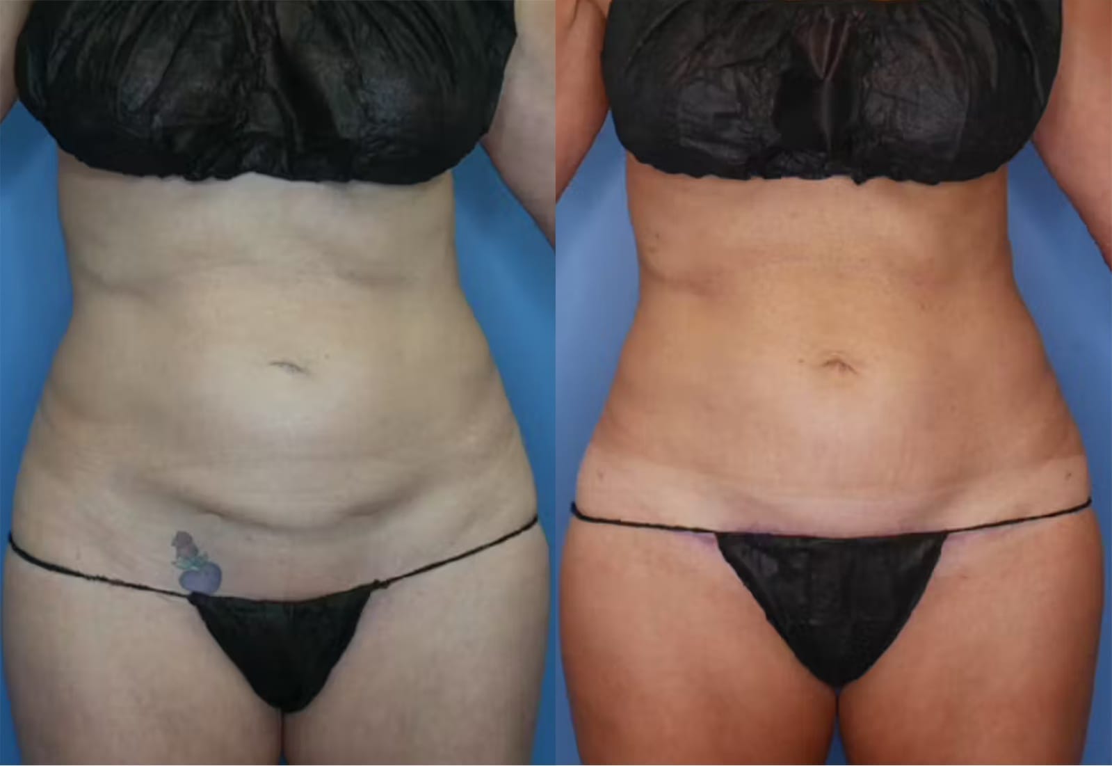 Before and After Image: Mini Tummy Tuck - front