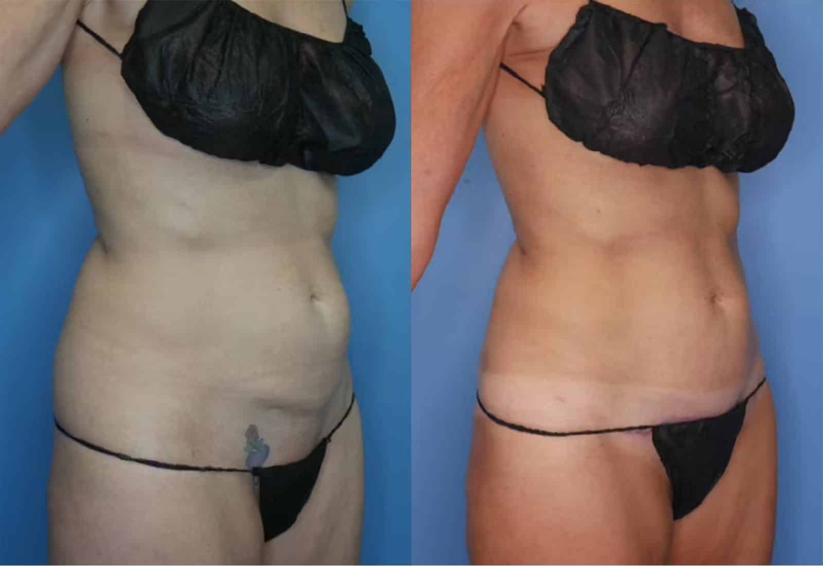 Before and After Image: Mini Tummy Tuck - right-front-oblique