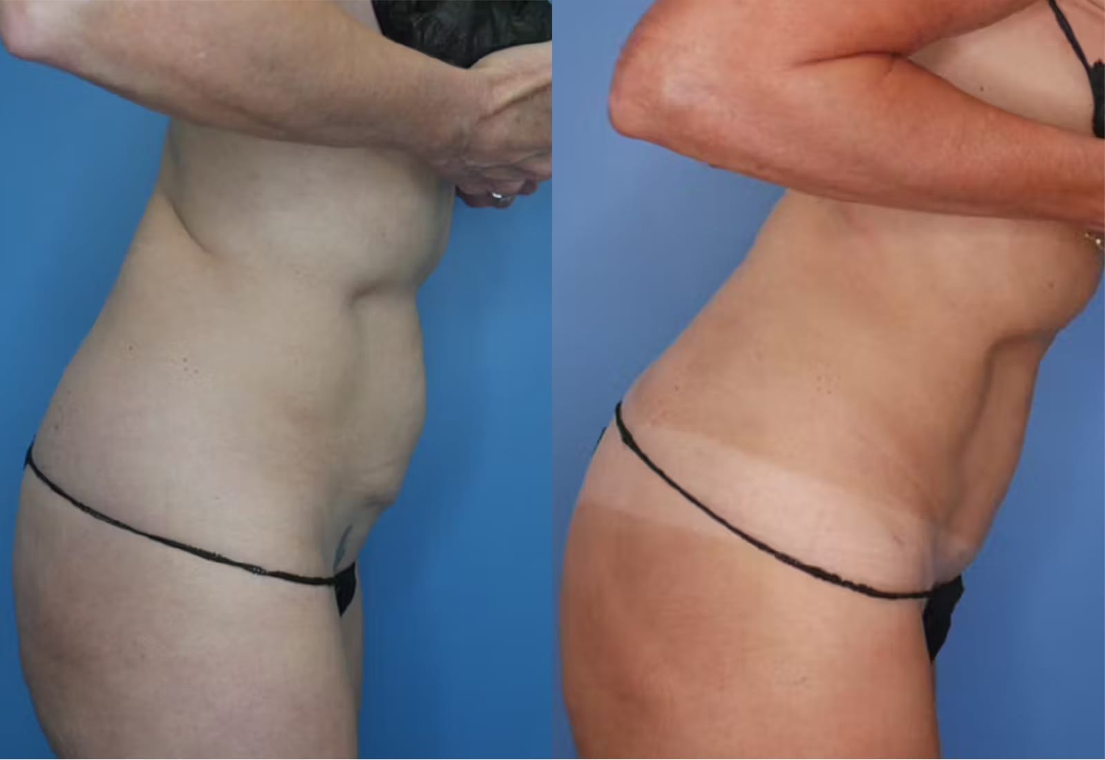Before and After Image: Mini Tummy Tuck - right-side