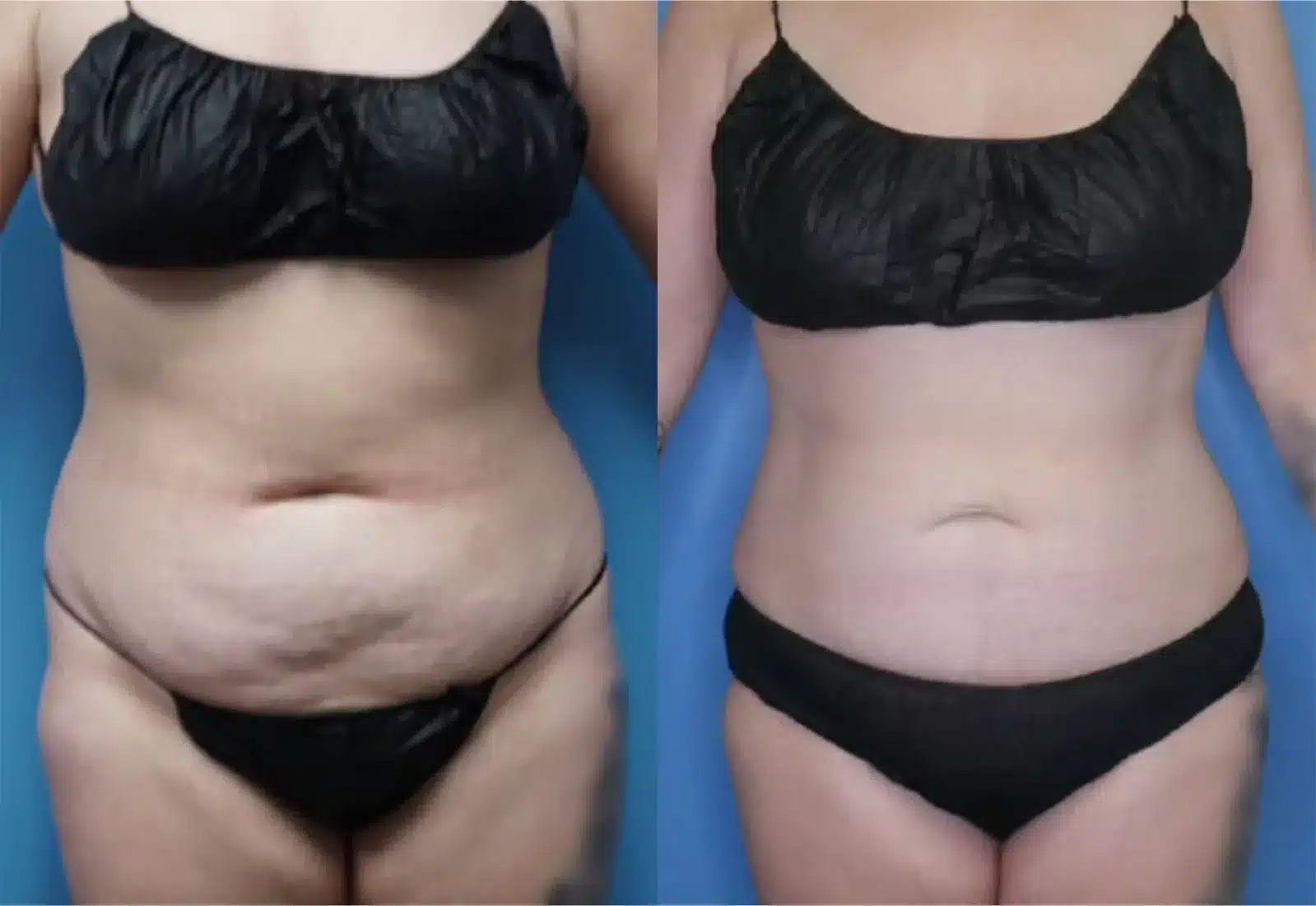 Before and After Image: Mini Tummy Tuck - front