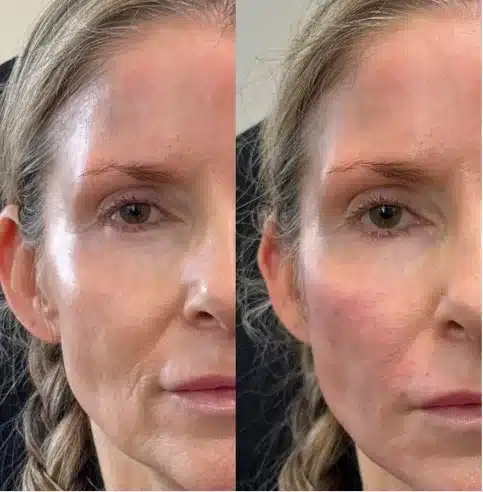Before and After Image: RHA Fillers - front