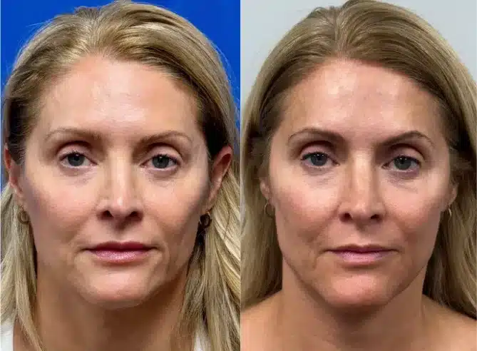 Before and After Image: RHA Fillers - front