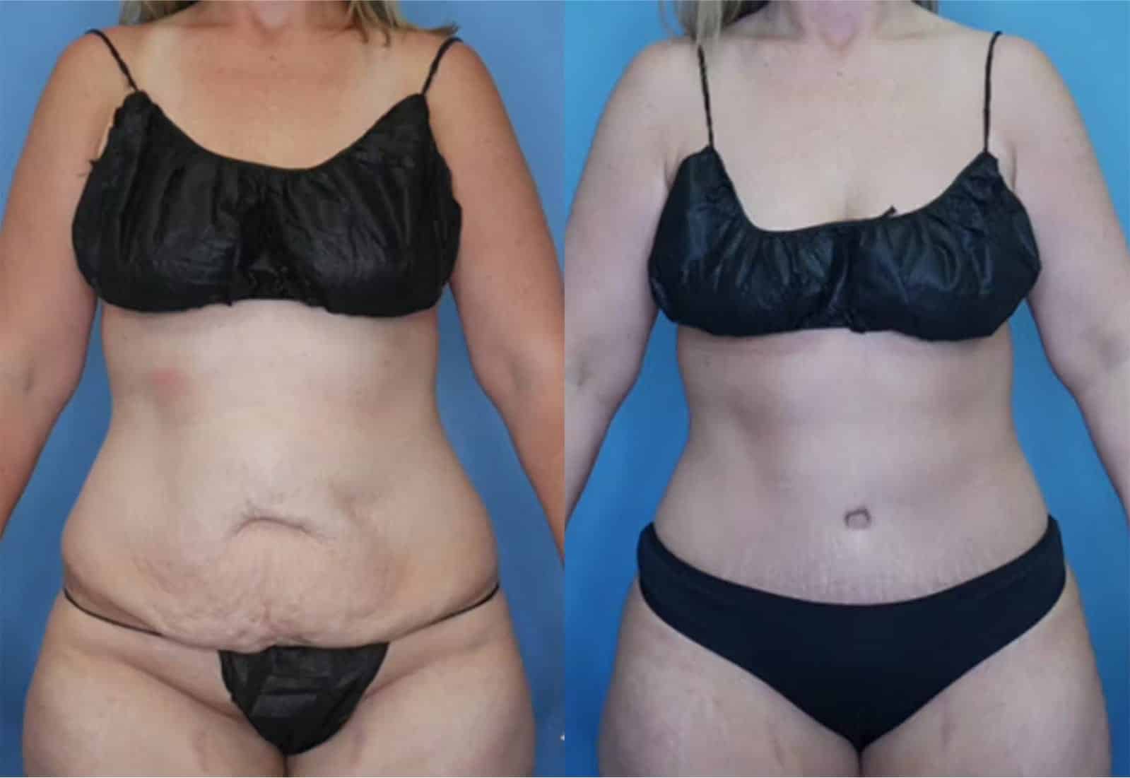 Before and After Image: Tummy Tuck (Abdominoplasty) - front
