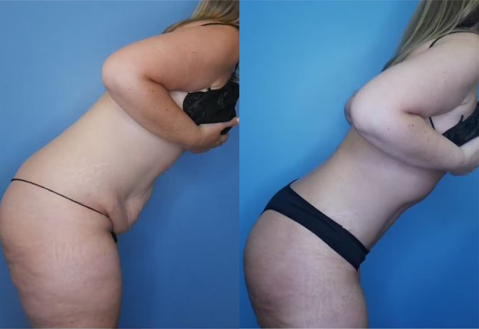 Before and After Image: Tummy Tuck (Abdominoplasty) - other