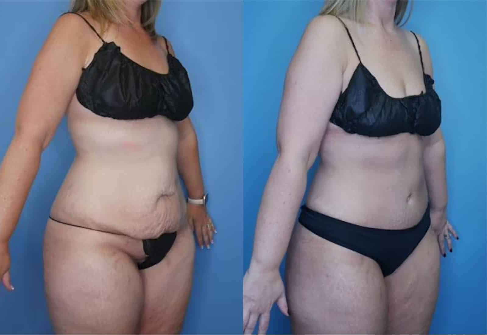 Before and After Image: Tummy Tuck (Abdominoplasty) - right-front-oblique