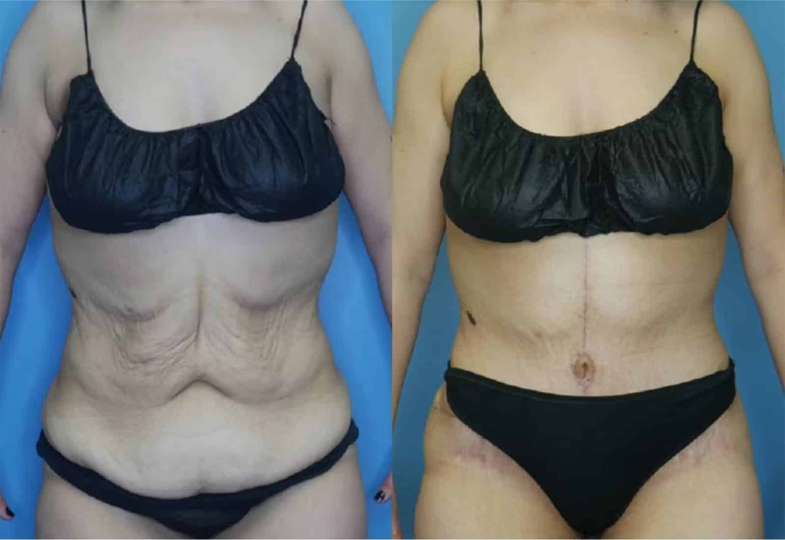 Before and After Image: Tummy Tuck (Abdominoplasty) - front