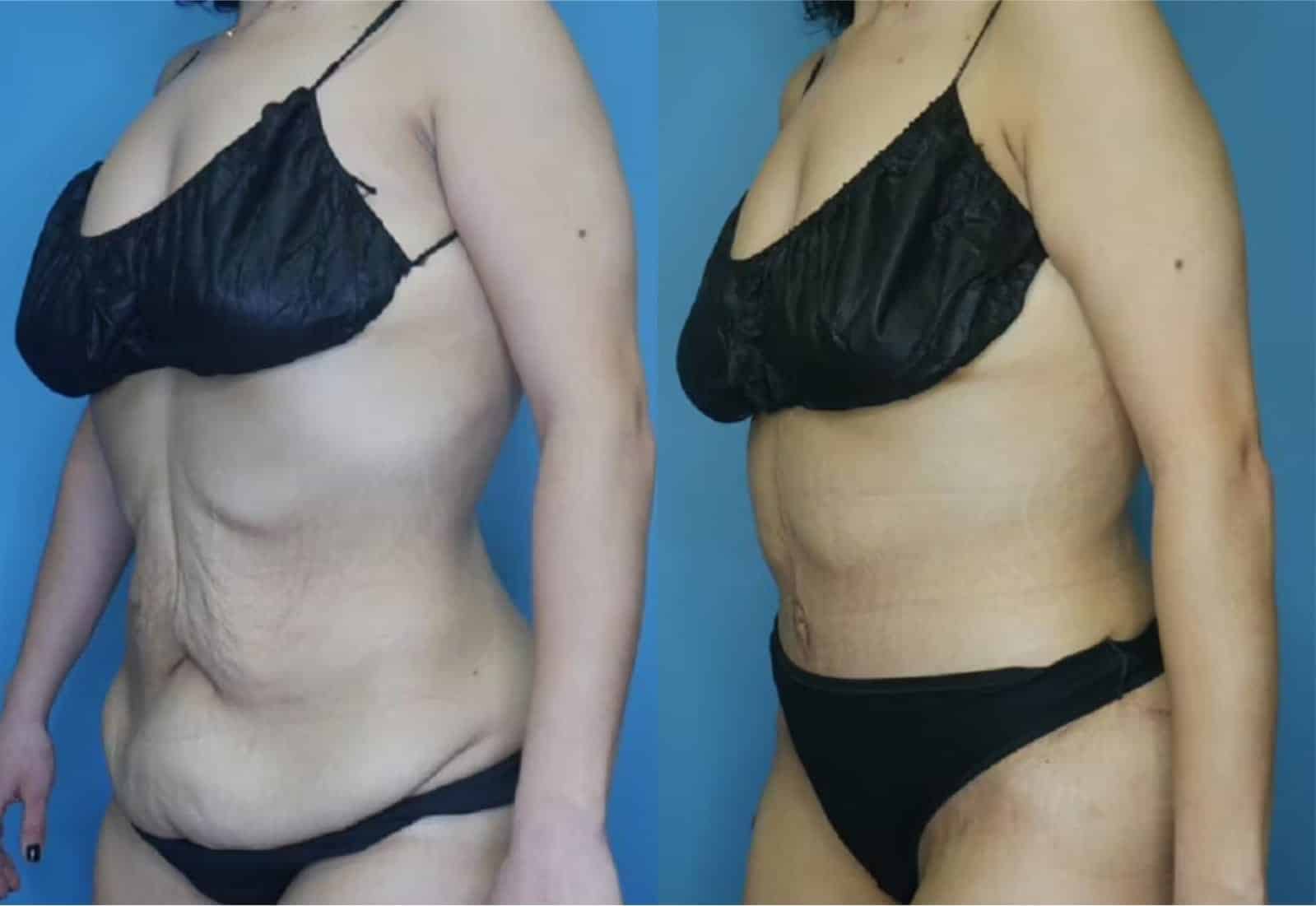 Before and After Image: Tummy Tuck (Abdominoplasty) - left-front-oblique