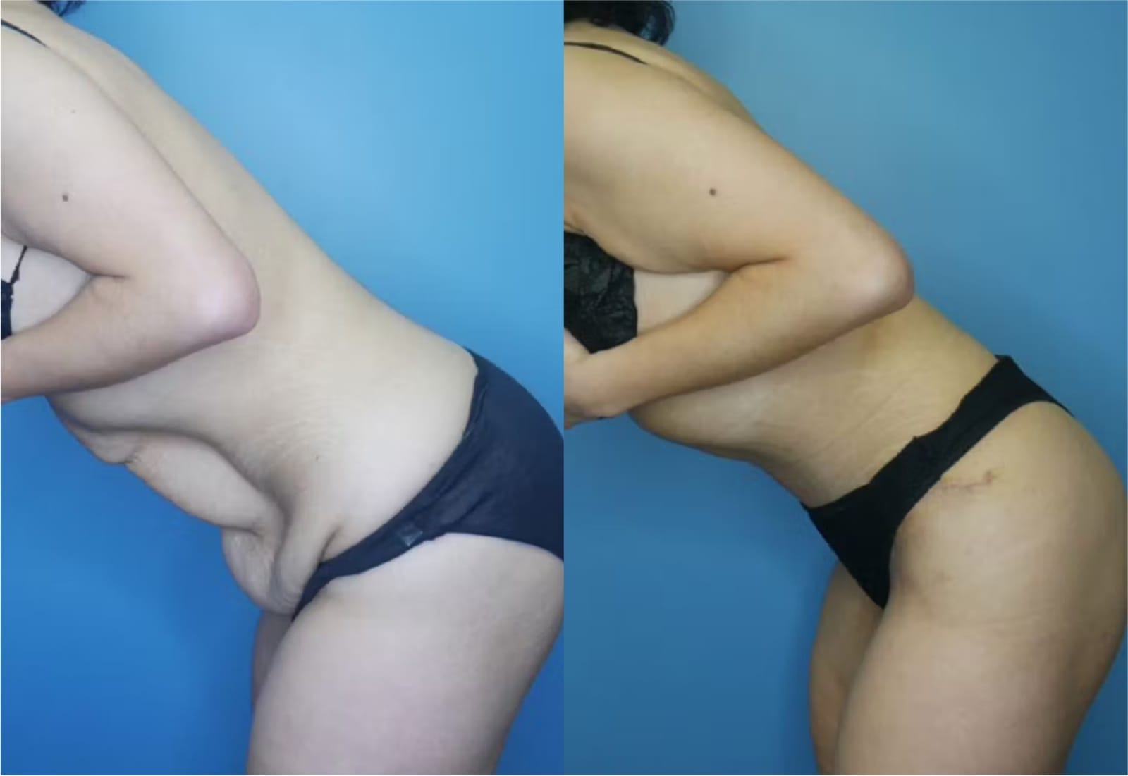 Before and After Image: Tummy Tuck (Abdominoplasty) - other