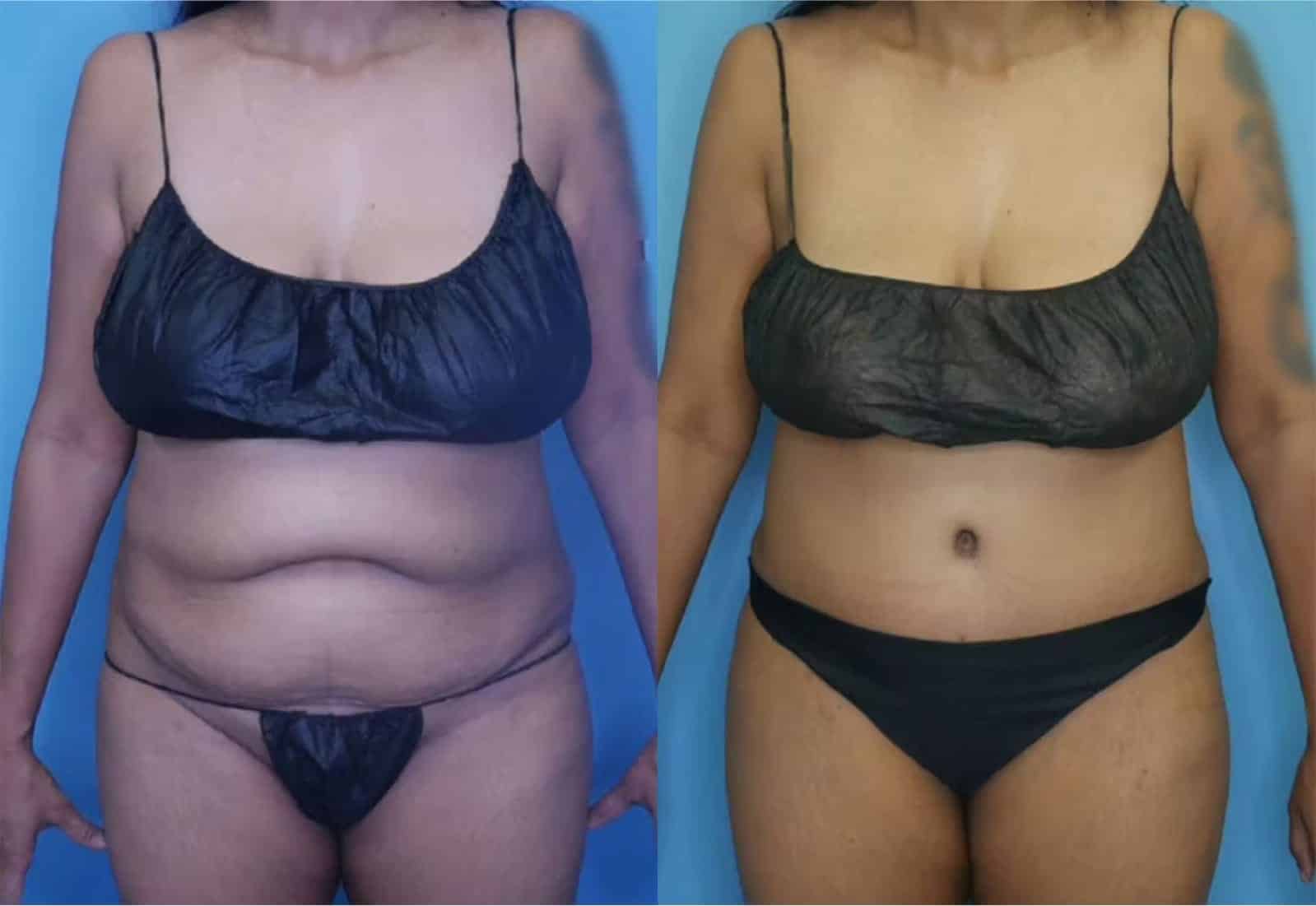 Before and After Image: Tummy Tuck (Abdominoplasty) - front