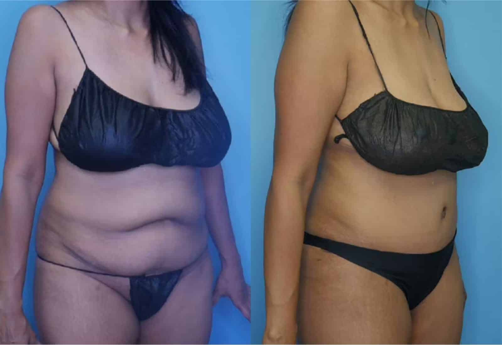 Before and After Image: Tummy Tuck (Abdominoplasty) - right-front-oblique