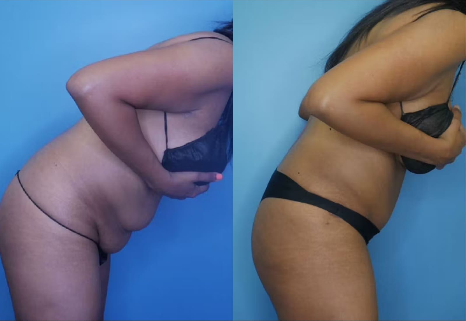 Before and After Image: Tummy Tuck (Abdominoplasty) - other