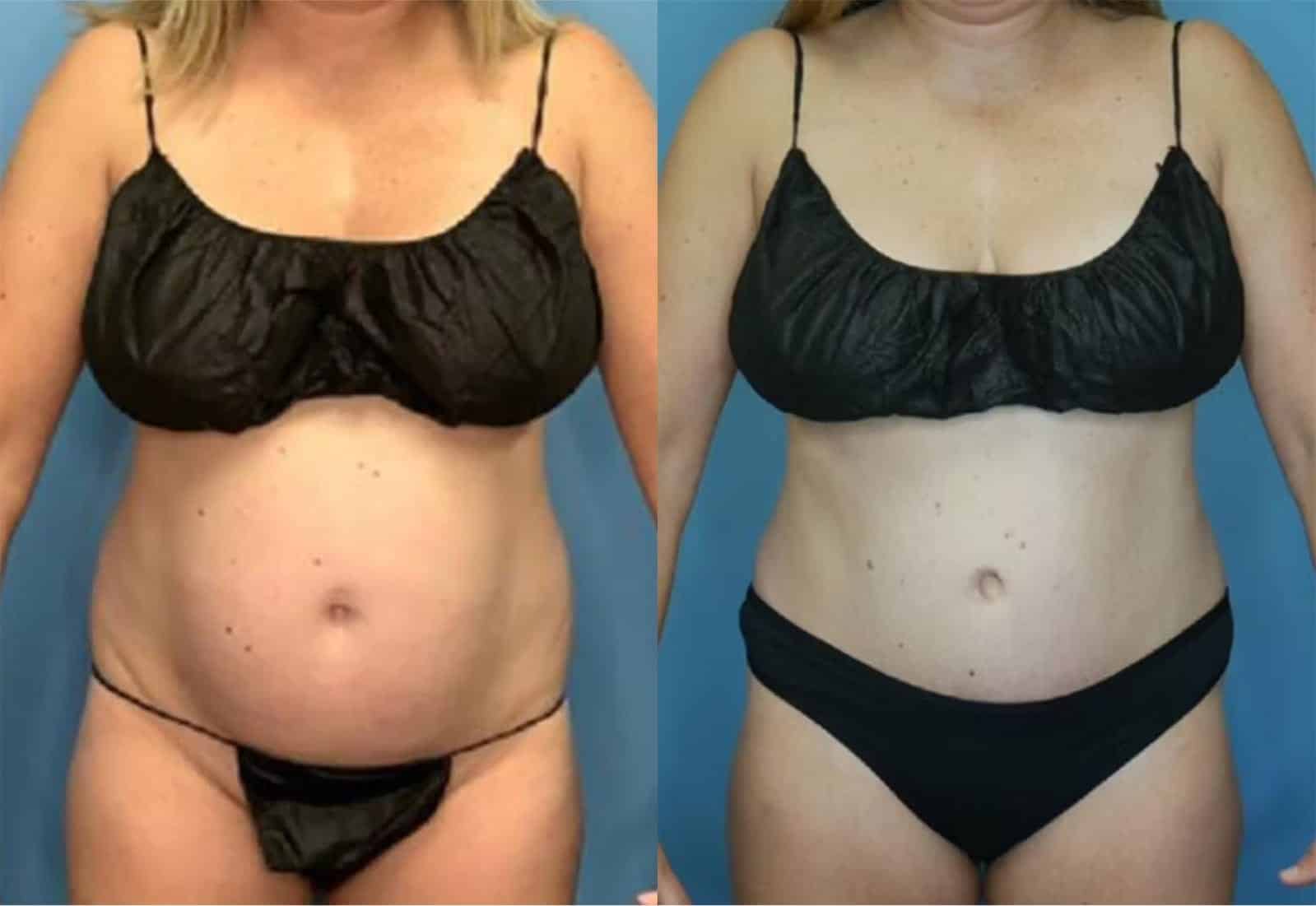 Before and After Image: Tummy Tuck (Abdominoplasty) - front