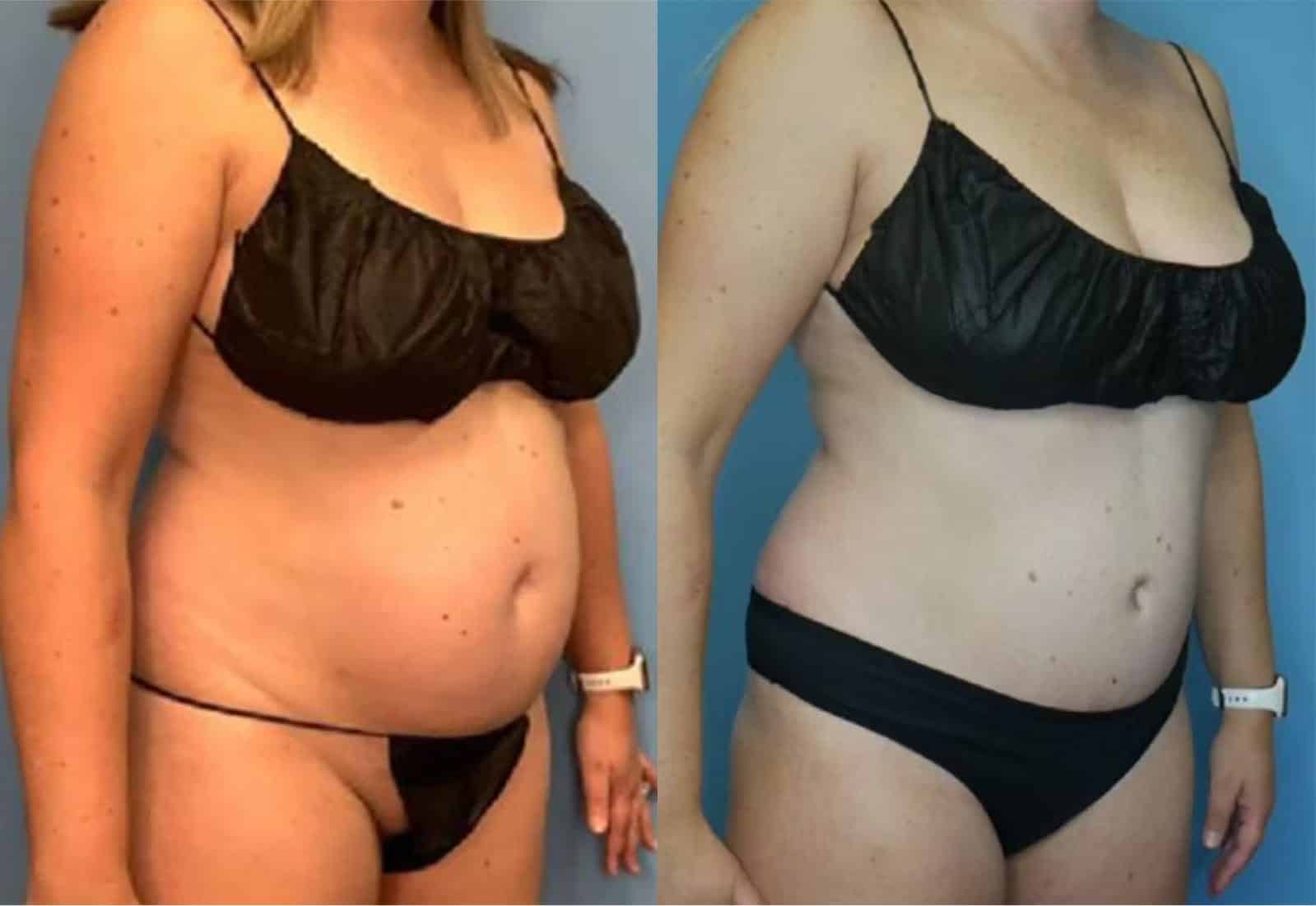 Before and After Image: Tummy Tuck (Abdominoplasty) - right-front-oblique