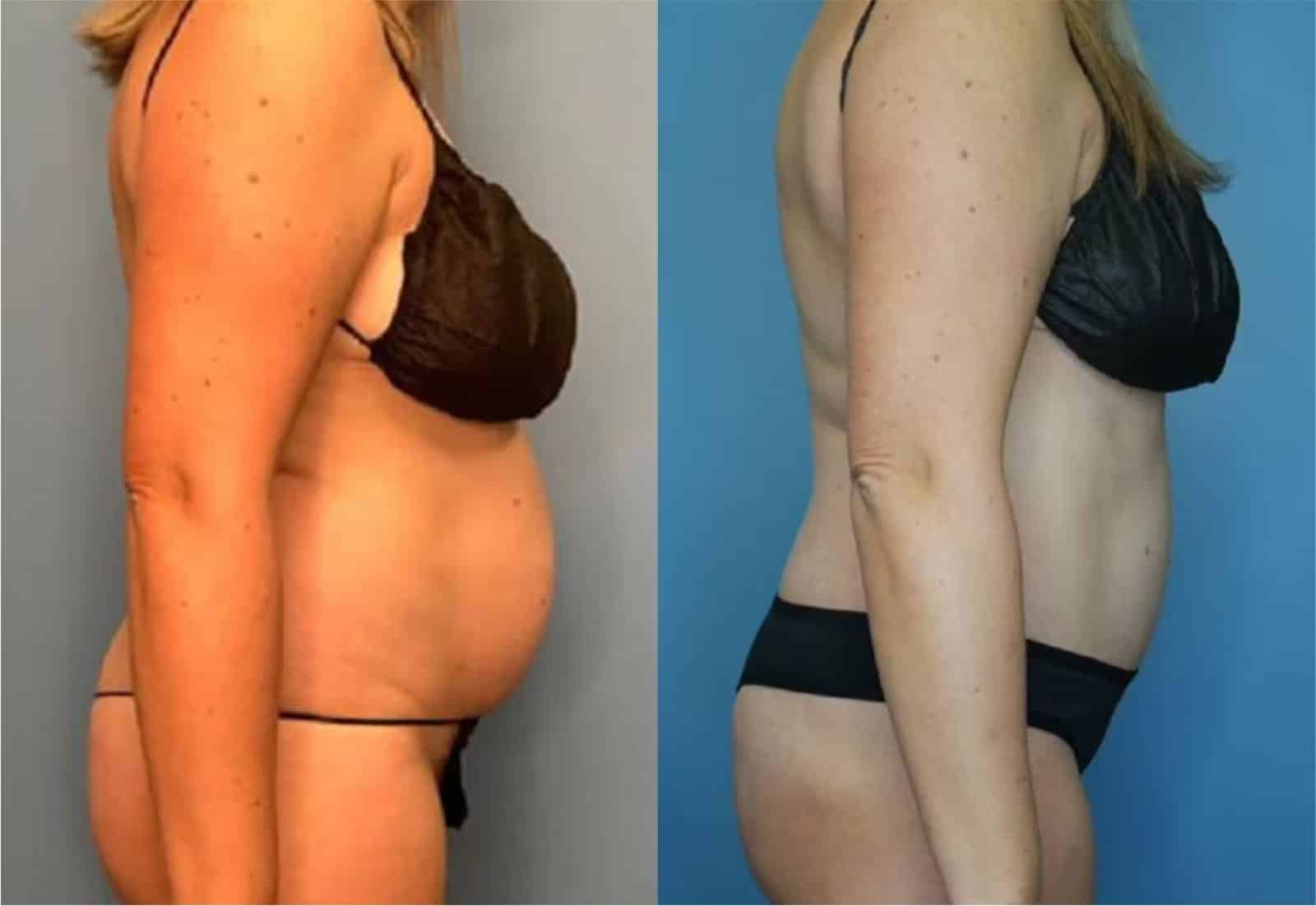 Before and After Image: Tummy Tuck (Abdominoplasty) - right-side