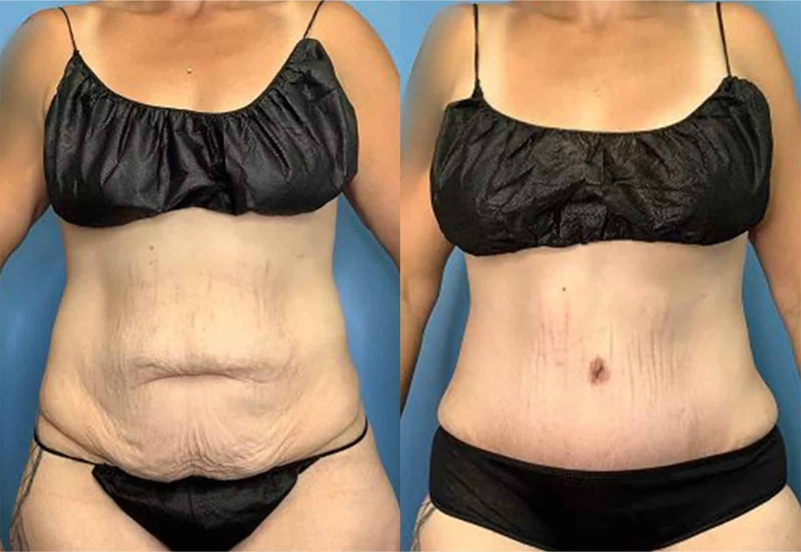 Before and After Image: Tummy Tuck (Abdominoplasty) - front