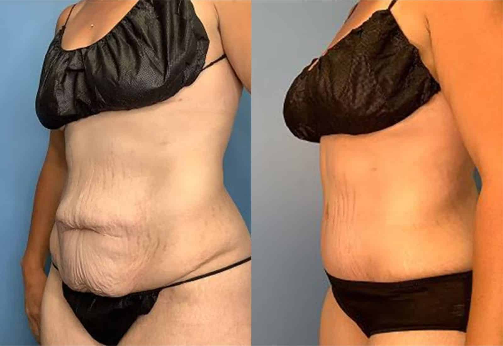 Before and After Image: Tummy Tuck (Abdominoplasty) - left-front-oblique